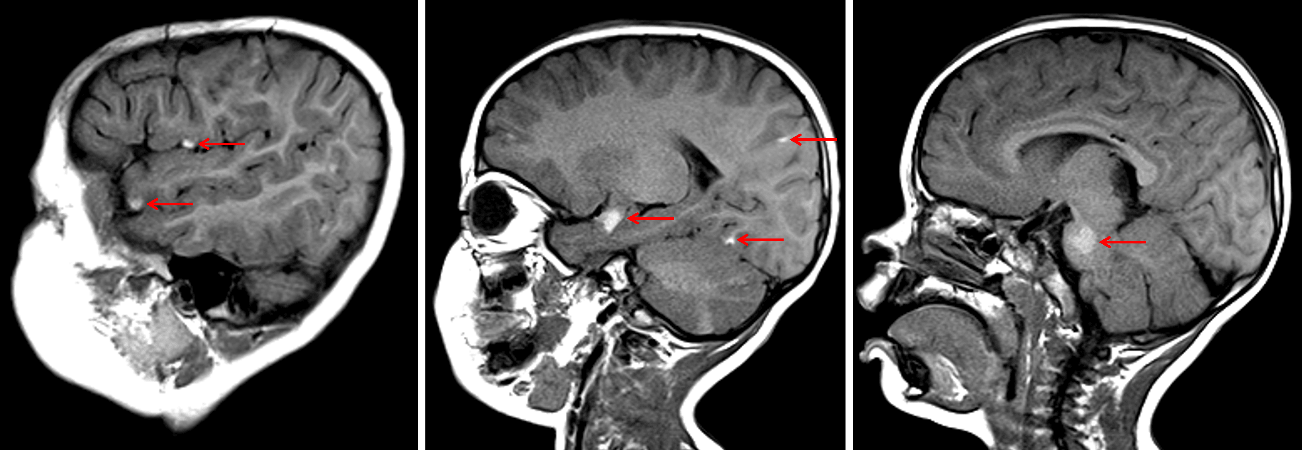 Multiple T1 hyperintense lesions scattered along the surface of the brain and brainstem (red arrows) in this patient with neurocutaneous melanosis.