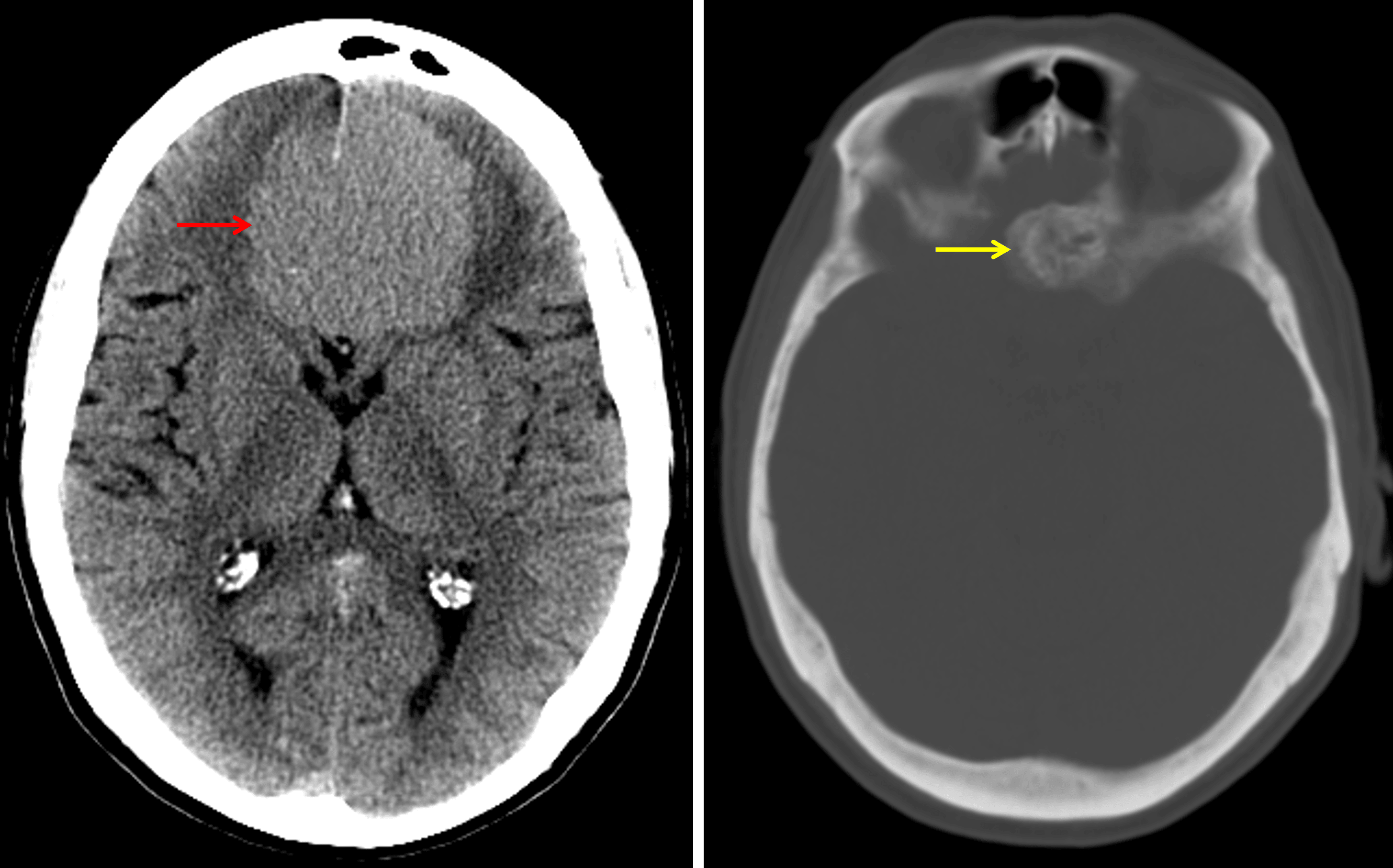 Typical CT appearance of an olfactory groove meningioma, which is hyperattenuating relative to the brain parenchyma (red arrow) and demonstrates adjacent hyperostosis (yellow arrow).