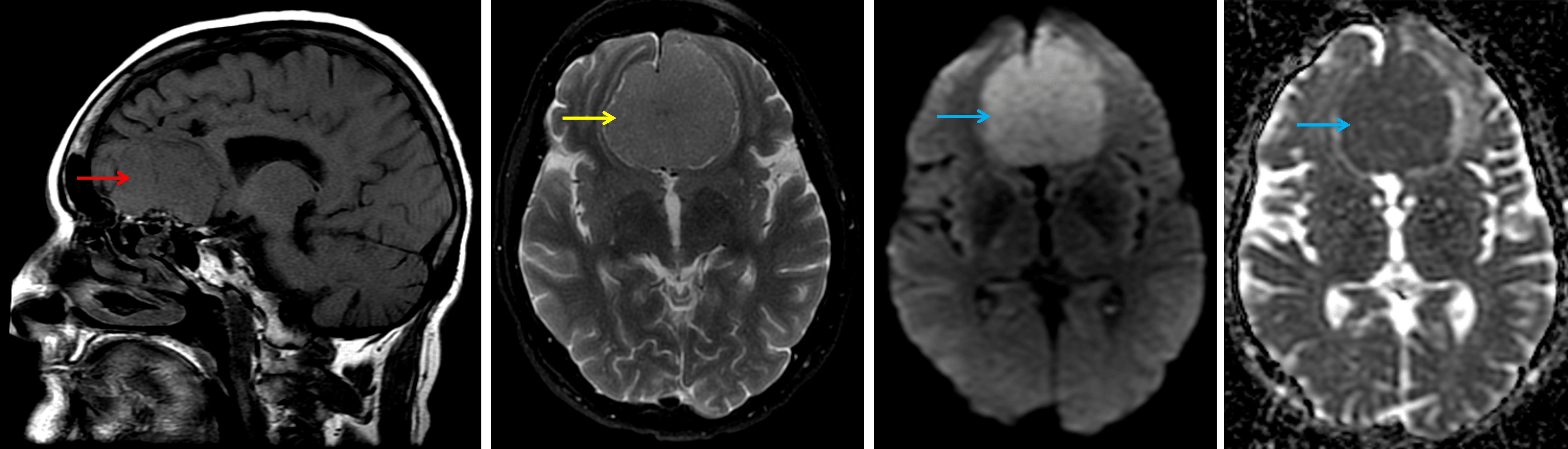 Typical MRI appearance of an olfactory groove meningioma, which is relatively isointense on T1 (red arrow) and T2 (yellow arrow) and demonstrates restricted diffusion (blue arrows).