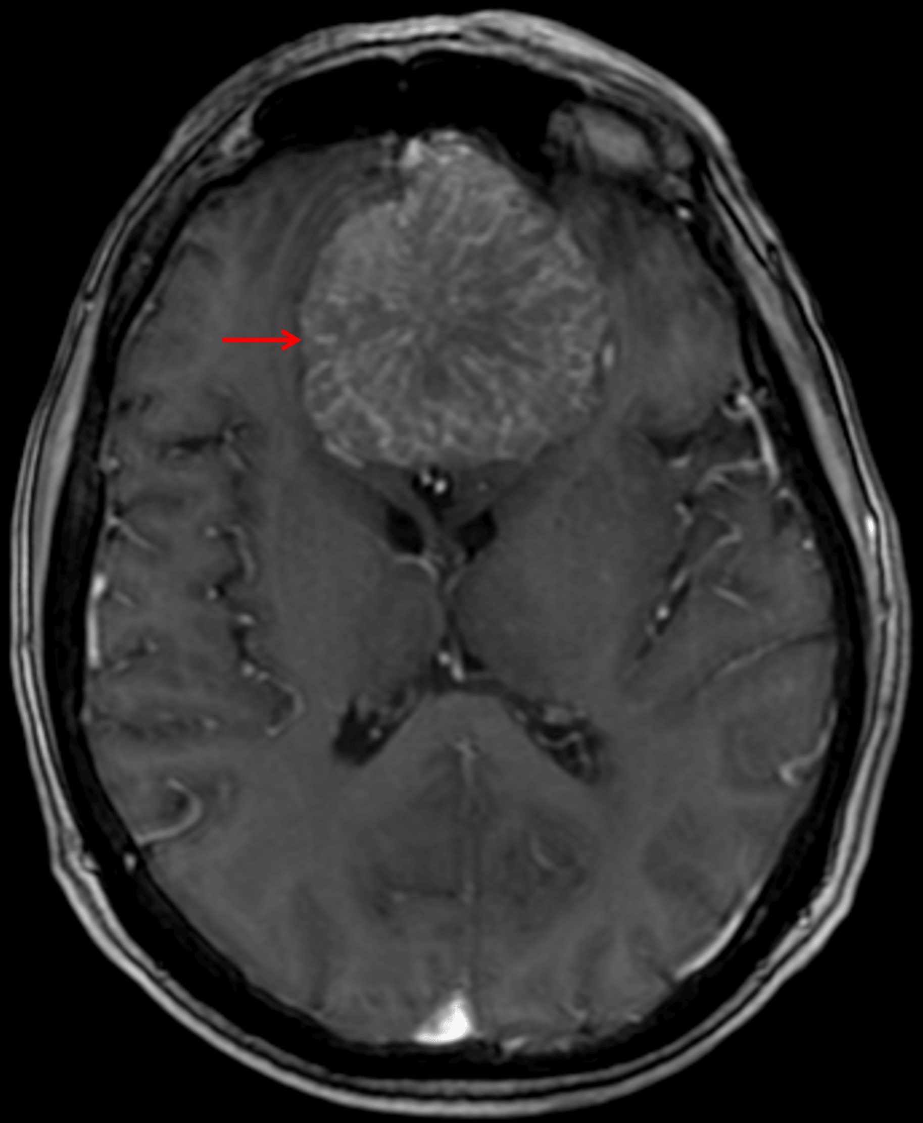 Internal spoke-wheel vascularity on postcontrast imaging (red arrow).