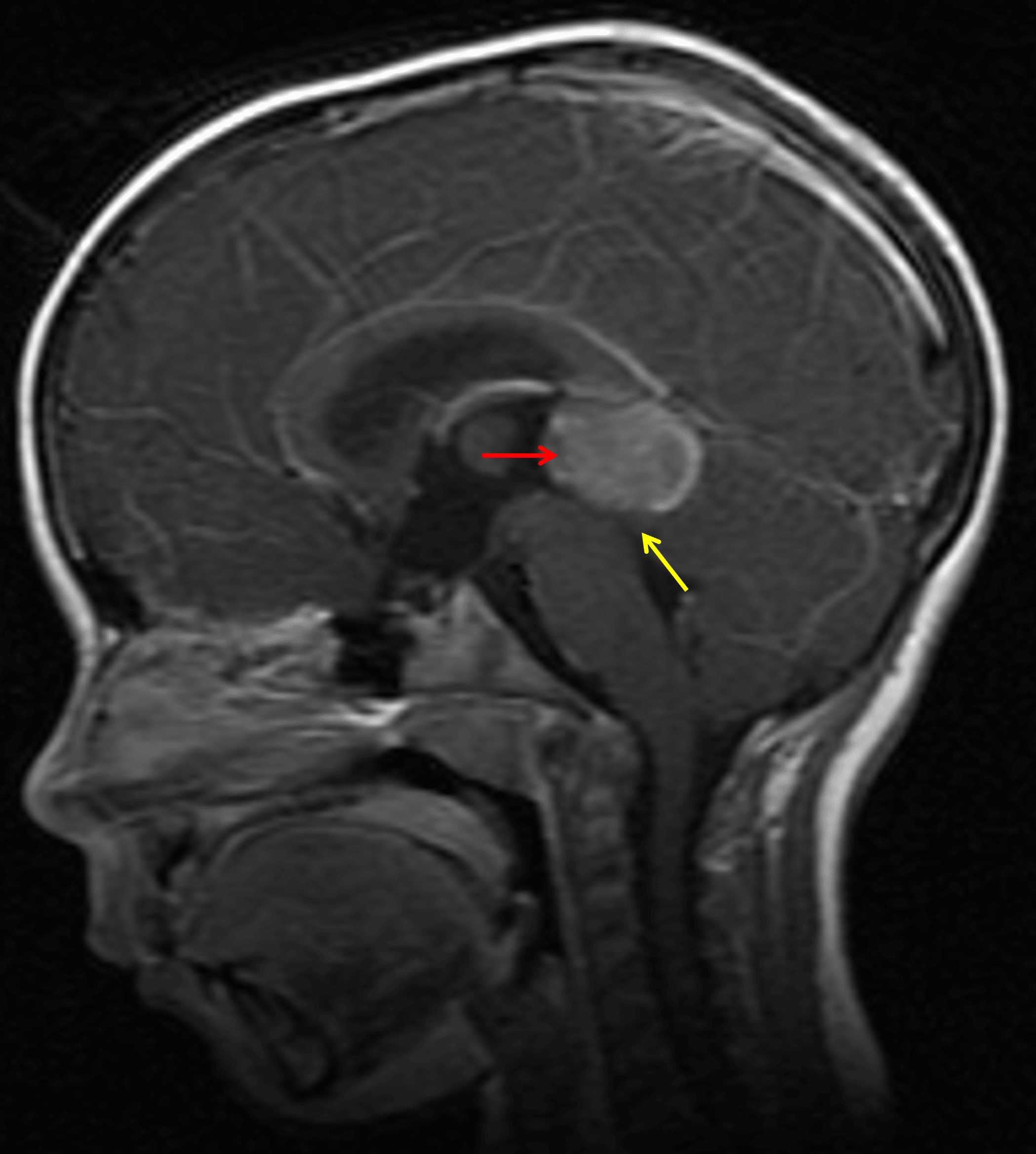Enhancing pineal region mass (red arrow) with downward mass effect on the tectum (yellow arrow).