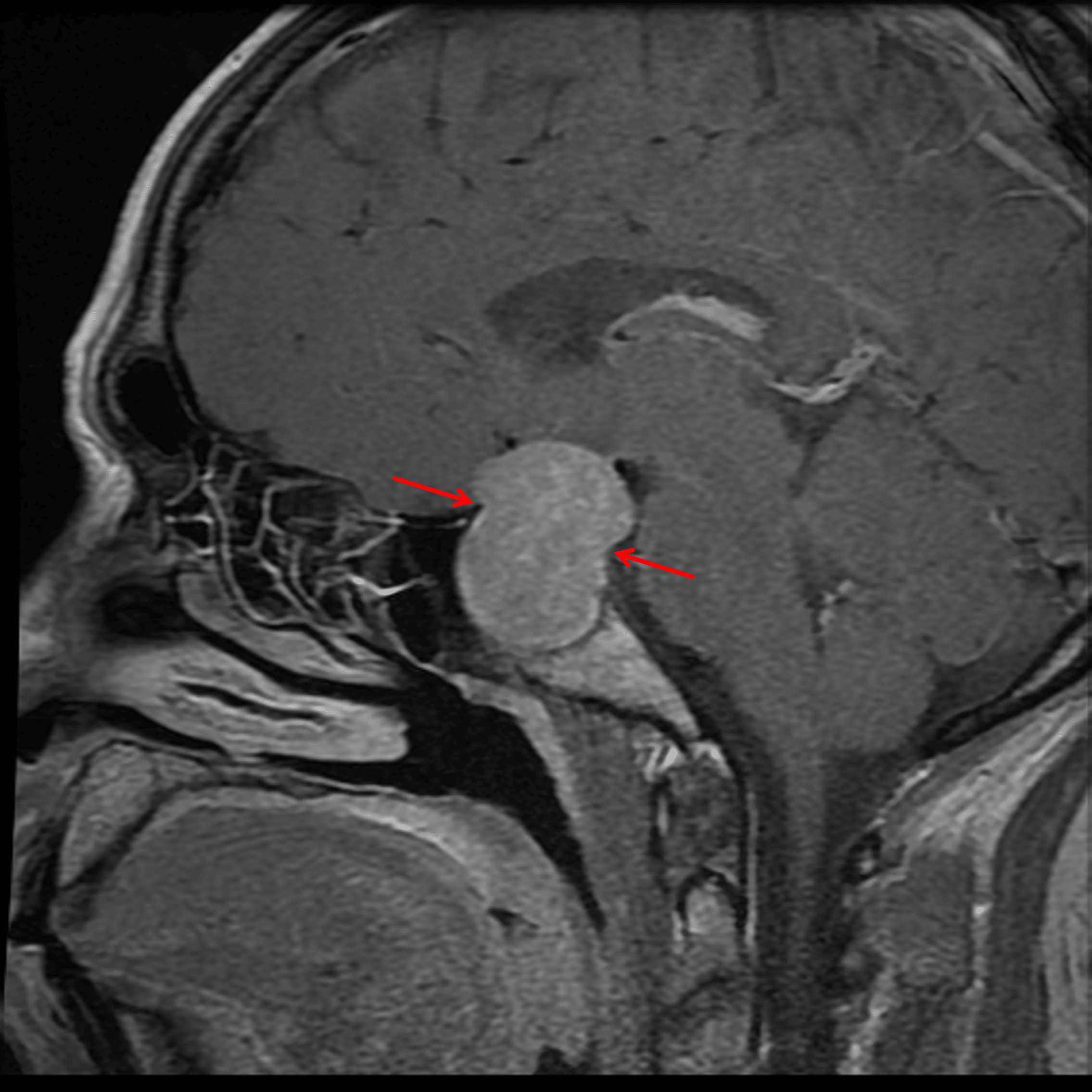 Diffusely enhancing sellar and suprasellar mass with waist-like narrowing in the region of the diaphragma sellae (red arrows).