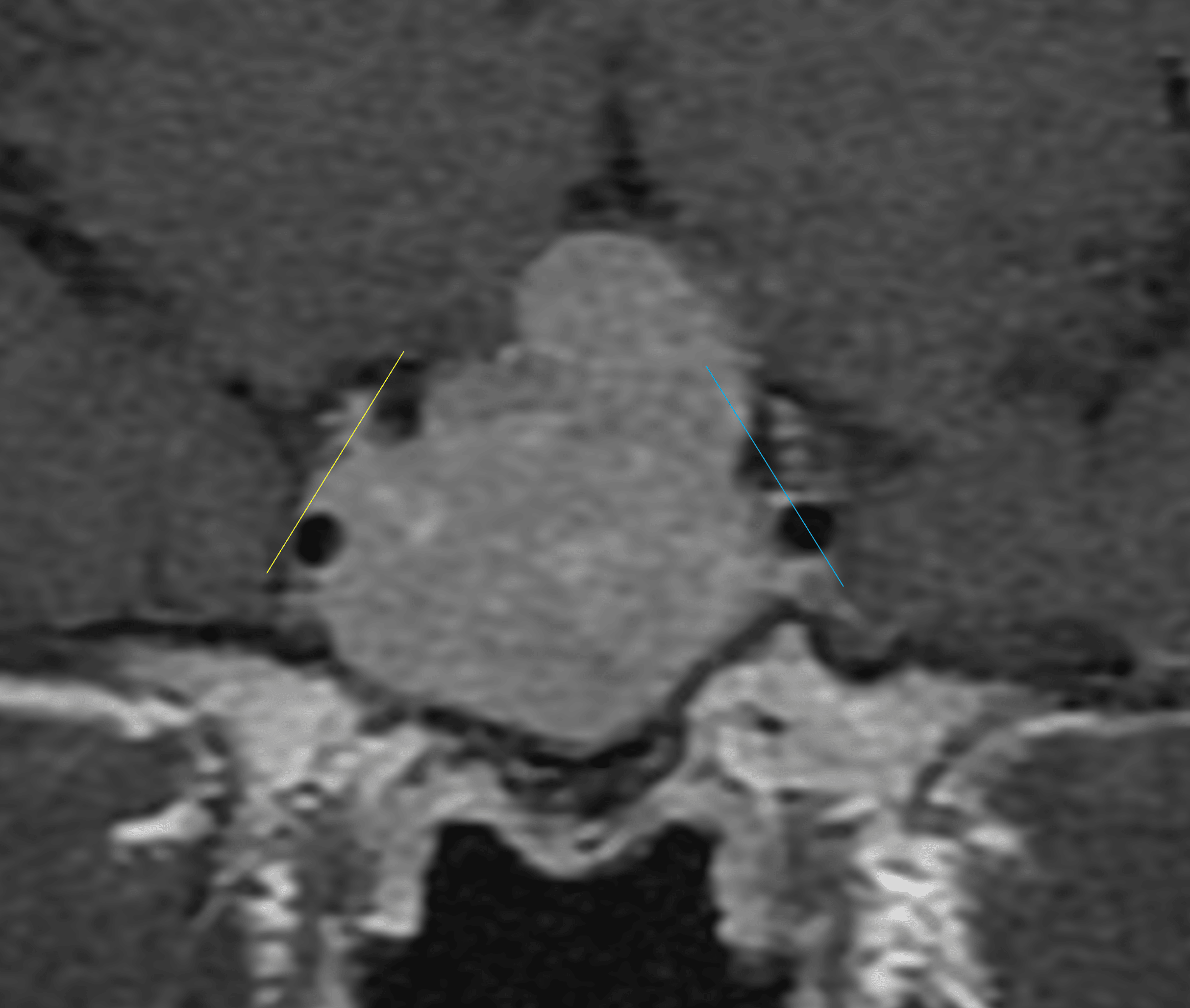 Tumor extends beyond the lateral tangent line on the right (yellow line) and the intercarotid line on the left (blue line).