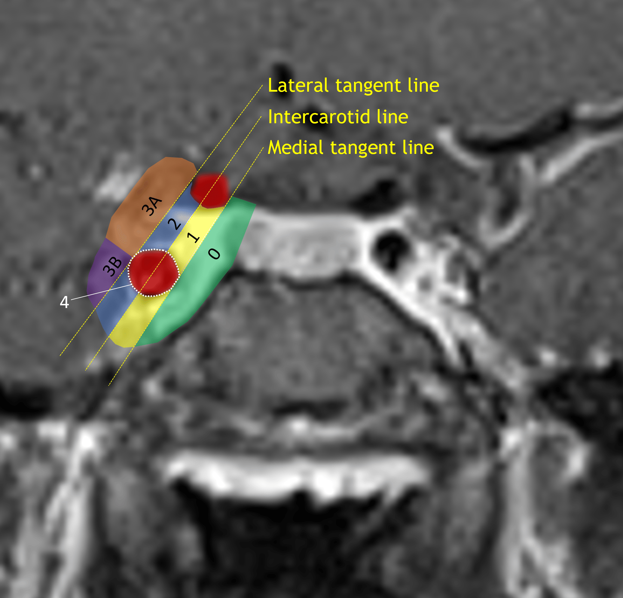 Knosp classification system.