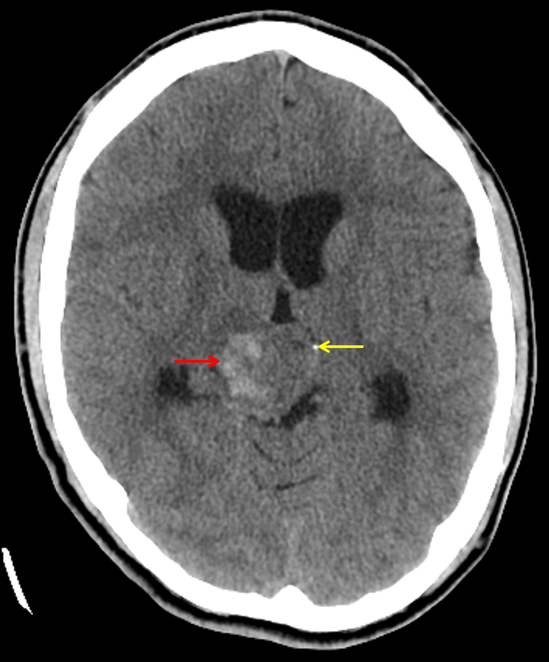 Pineal region mass with peripheral hyperattenuation (red arrow) and foci of mineralization (yellow arrow).