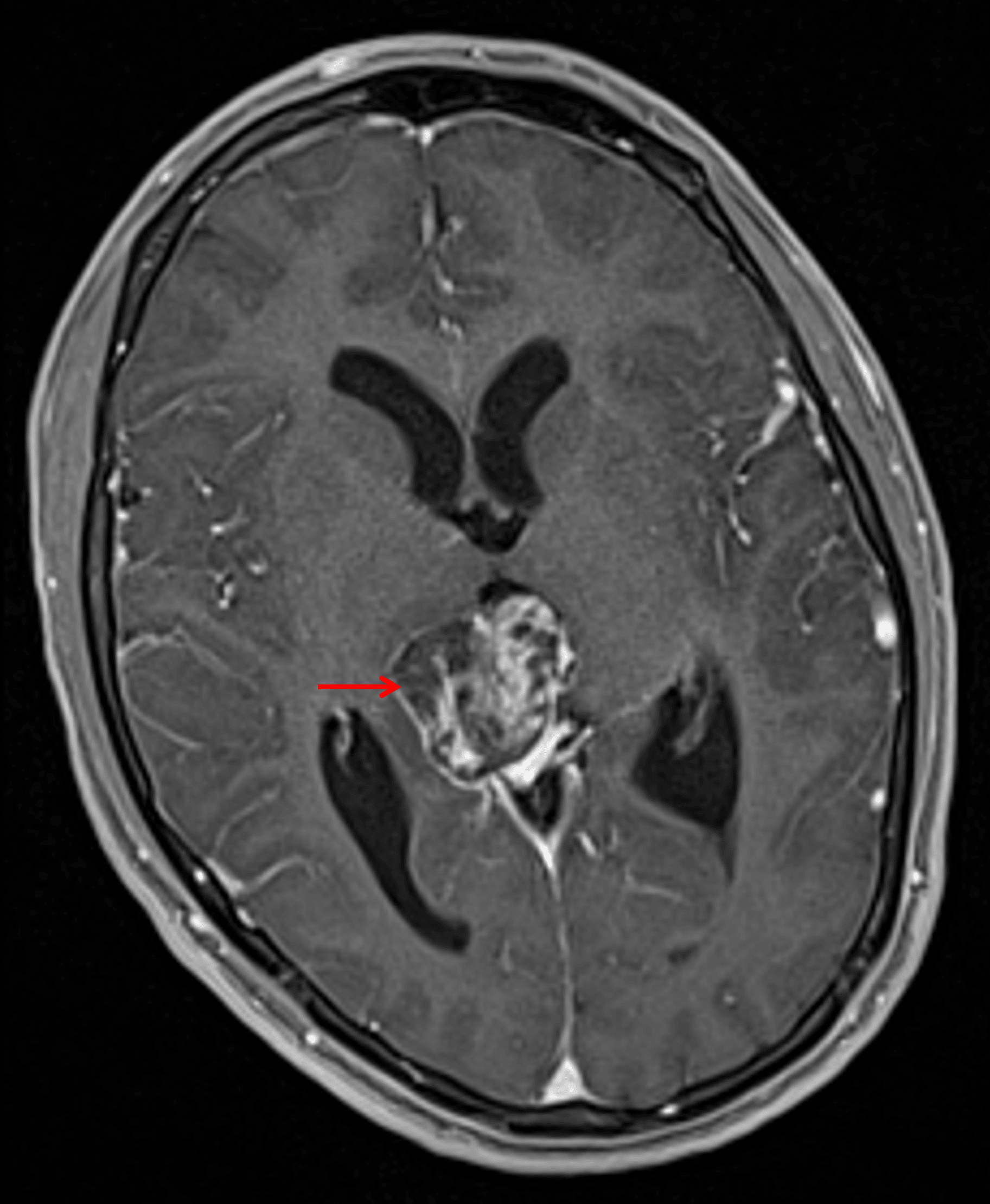 Corresponding heterogeneous enhancement (red arrow).