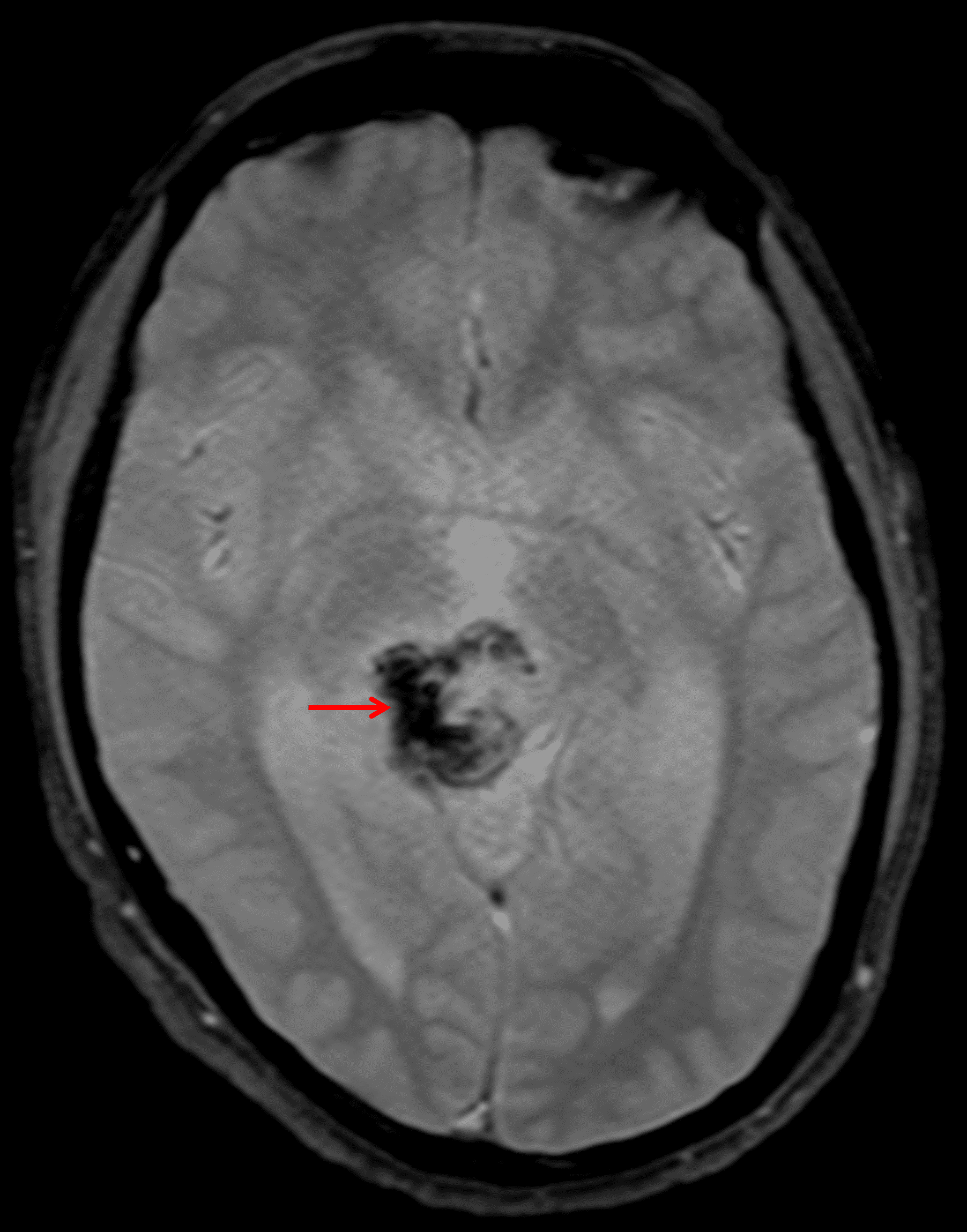 Susceptibility artifact along the right aspect of the mass (red arrow) likely relating to hemorrhage.
