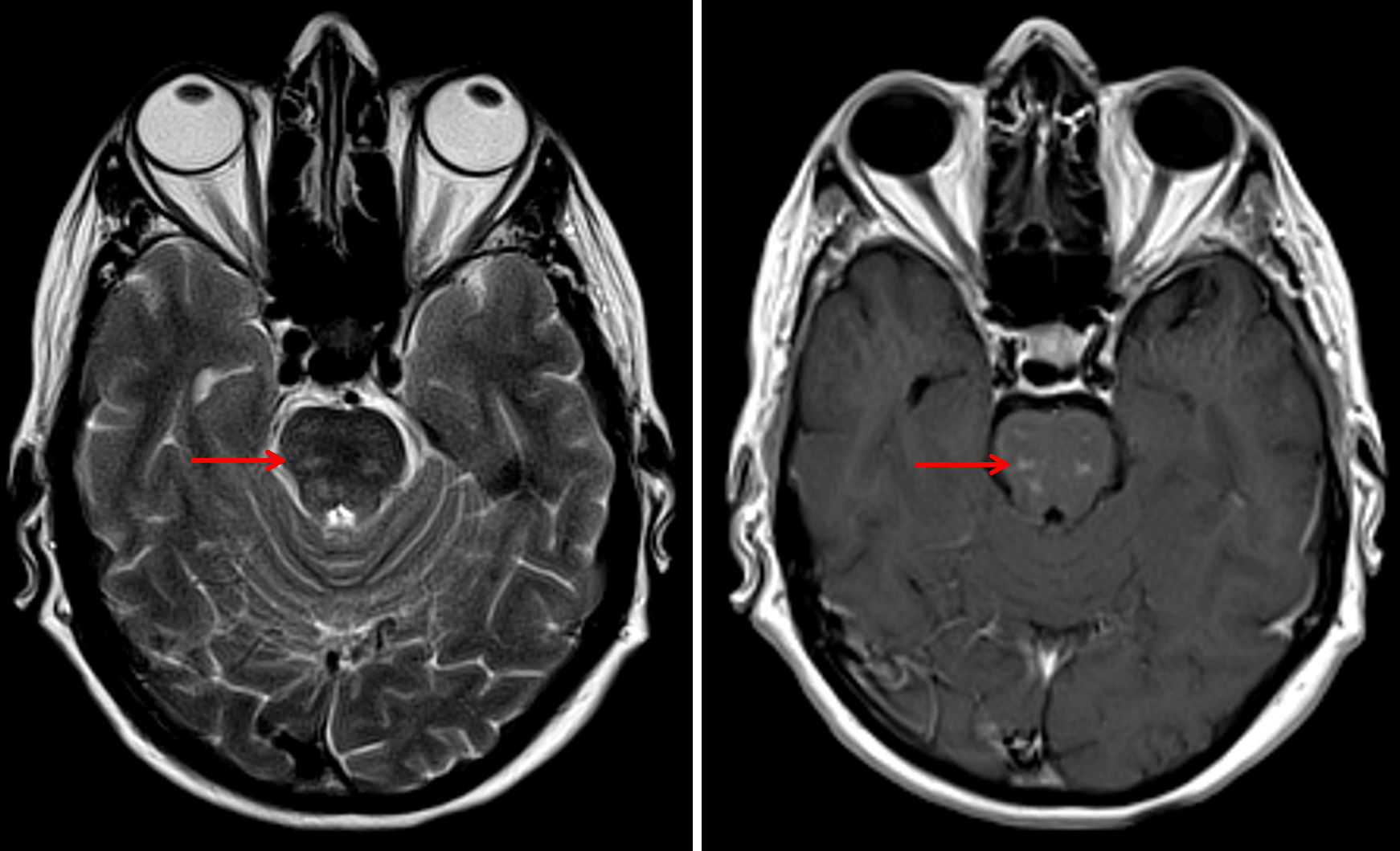 Relatively symmetric patchy T2 signal hyperintensity and enhancement in the pons (red arrows), which is a typical imaging appearance for CLIPPERS.
