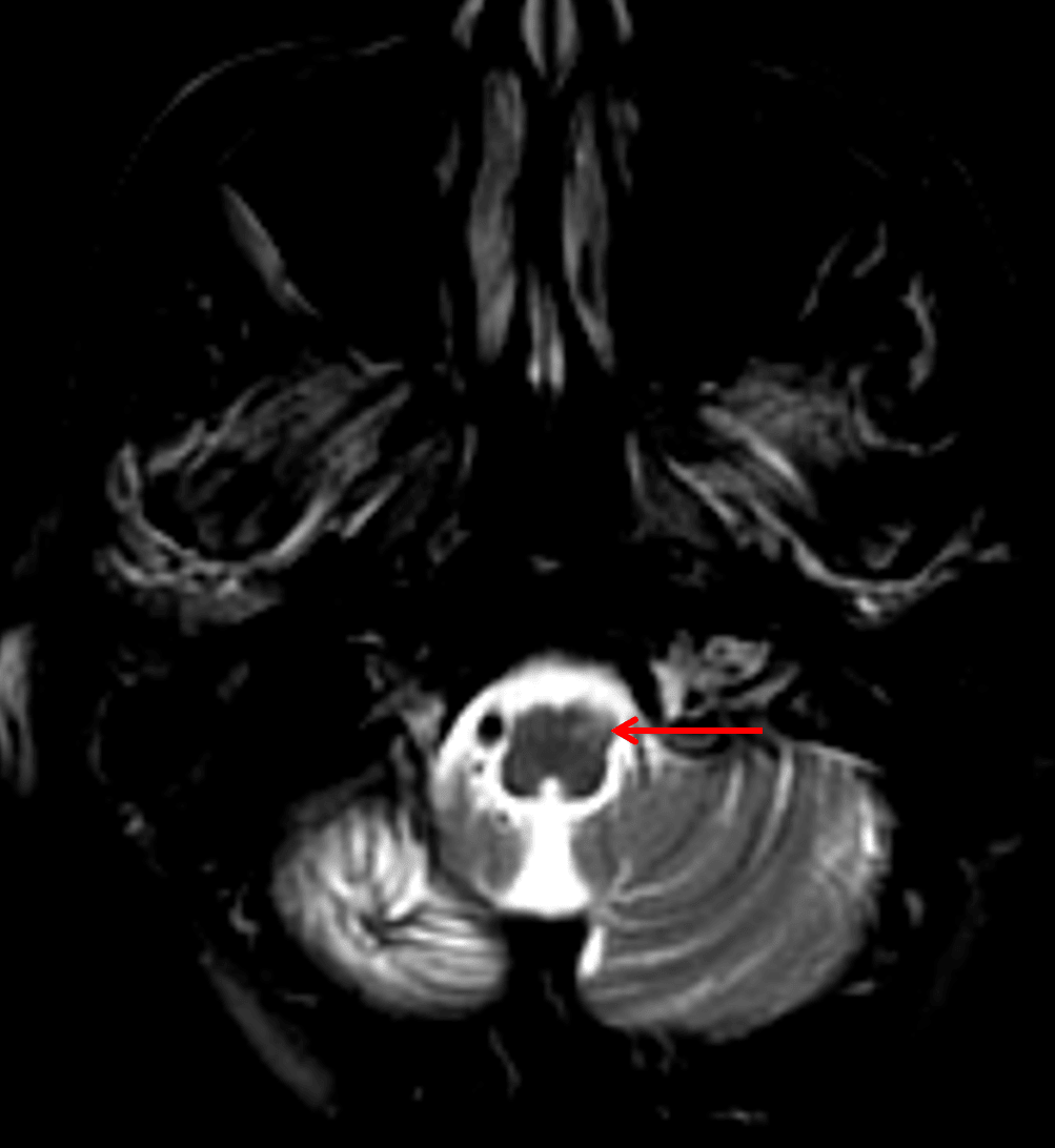 Interestingly, this patient later developed hypertrophic olivary degeneration (red arrow) contralateral to their dentate nucleus involvement.