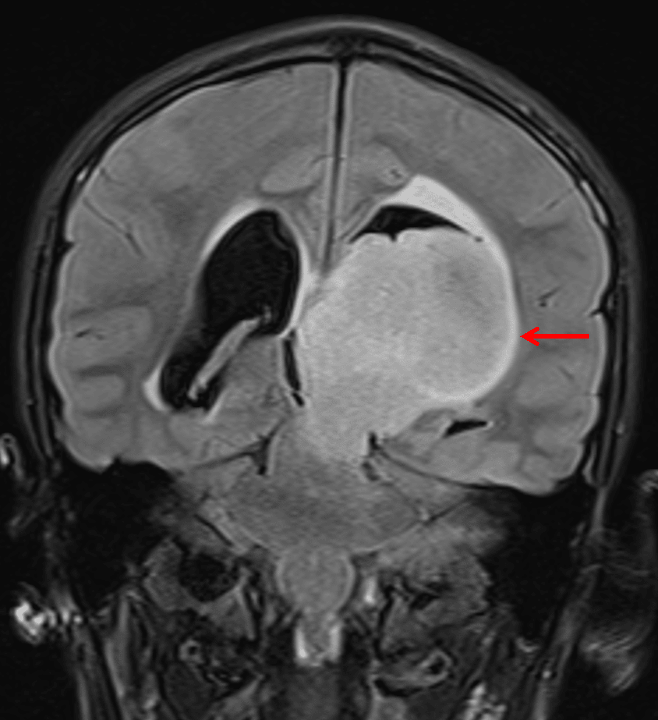 Large, relatively homogeneous T2/FLAIR hyperintense mass centered in the left thalamus (red arrow), consistent with a diffuse midline glioma.