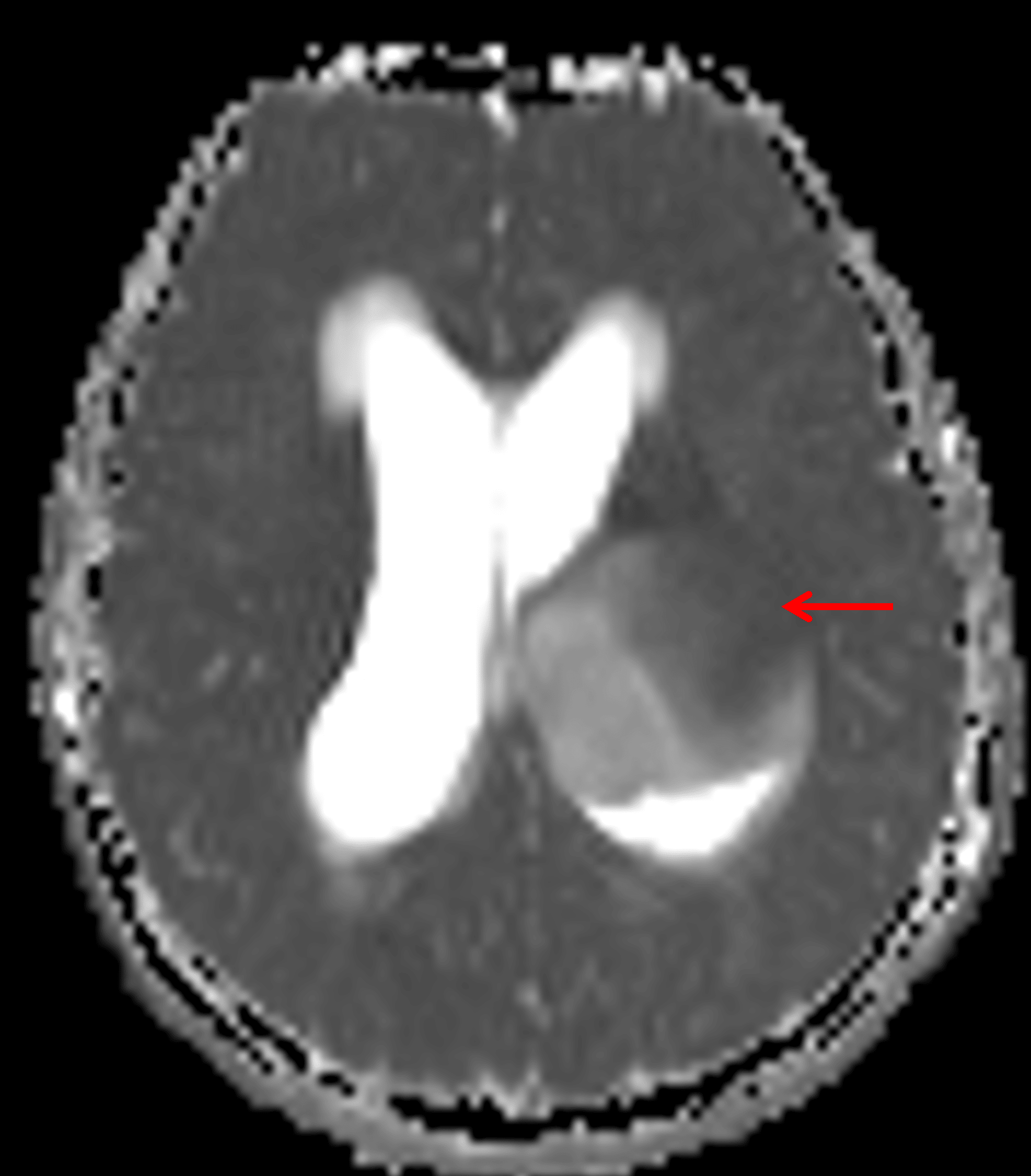 Area of relatively low ADC in the anterosuperior portion of the mass (red arrow), likely correlating with an area of higher cellularity.