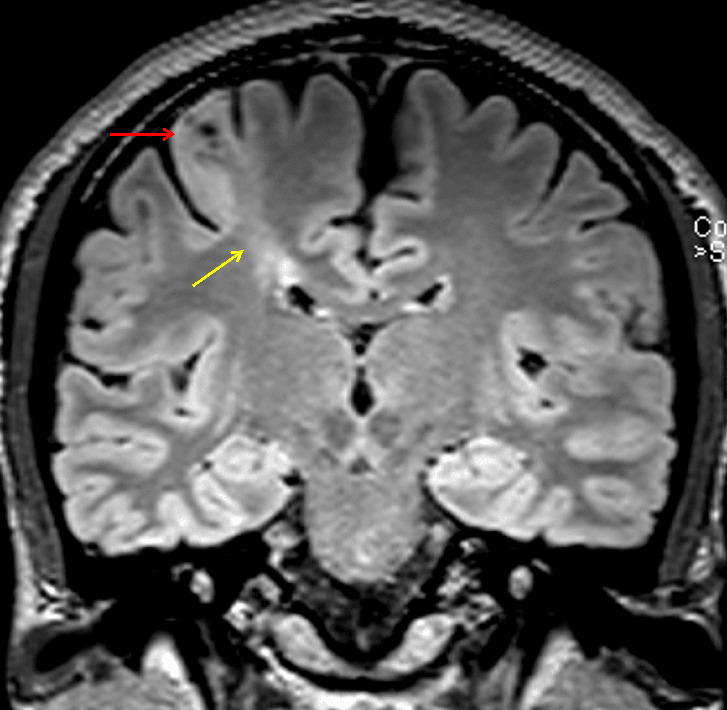 Abnormal cortical thickening and T2/FLAIR signal hyperintensity (red arrow) with blurring of the gray-white junction and a band of T2/FLAIR signal hyperintensity extending to the underlying ventricular margin (yellow arrow).