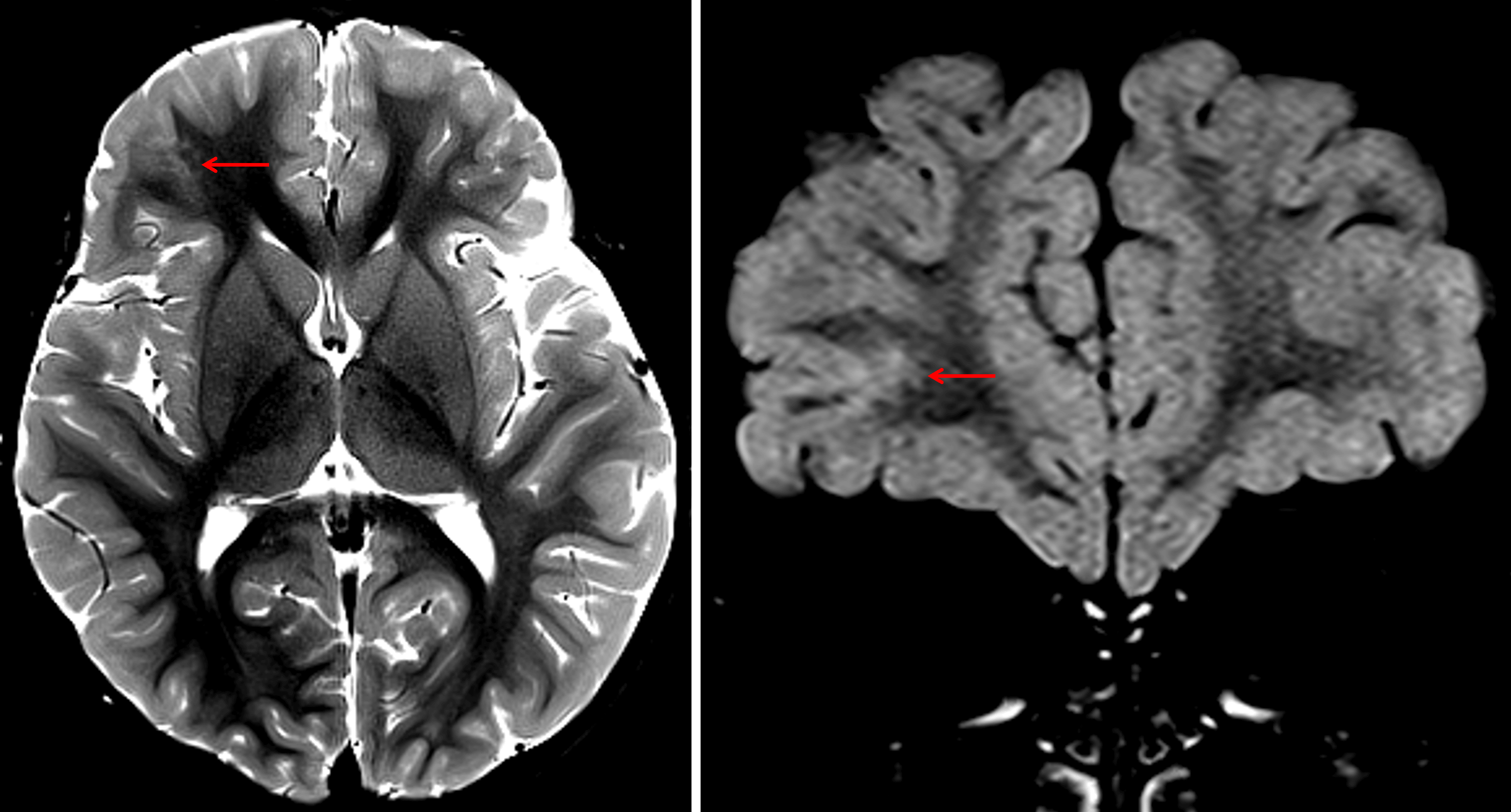 Nonexpansile T2/FLAIR hyperintense lesion involving the juxtacortical white matter and cortex of the inferior right frontal lobe with a projection of signal hyperintensity extending into the deep white matter (red arrows).