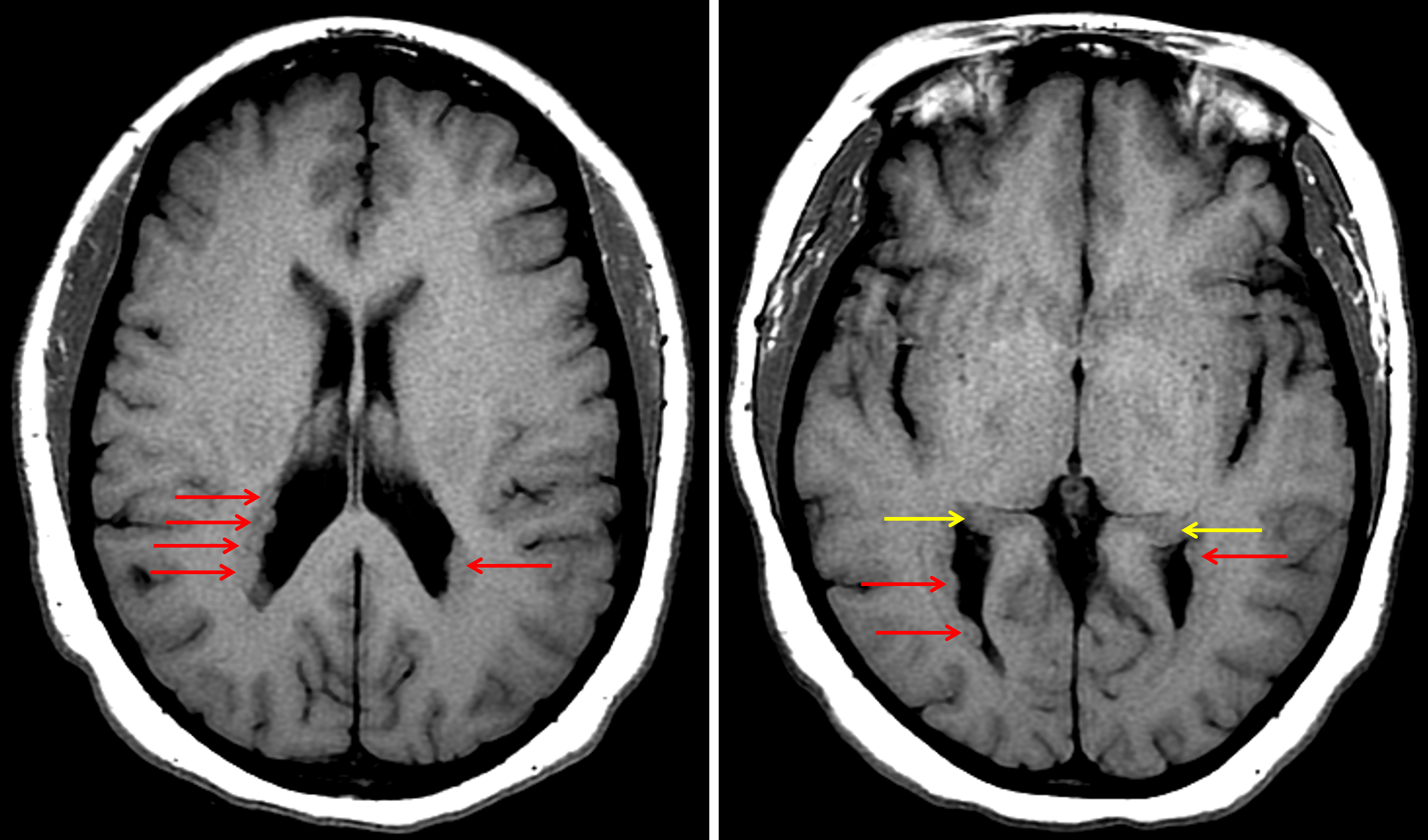 Multifocal nodular subependymal gray matter heterotopia (red arrows). Make sure not to mistake the caudate tails (yellow arrows) for gray matter heterotopia.