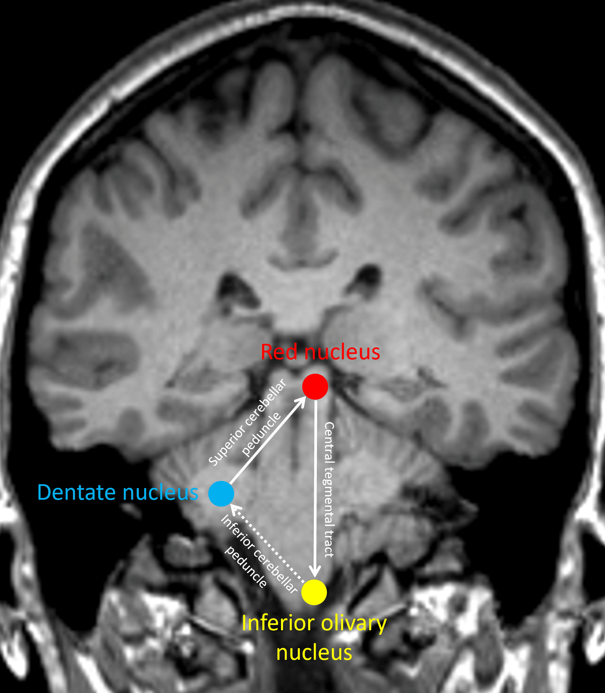 The infamous Guillain-Mollaret triangle.