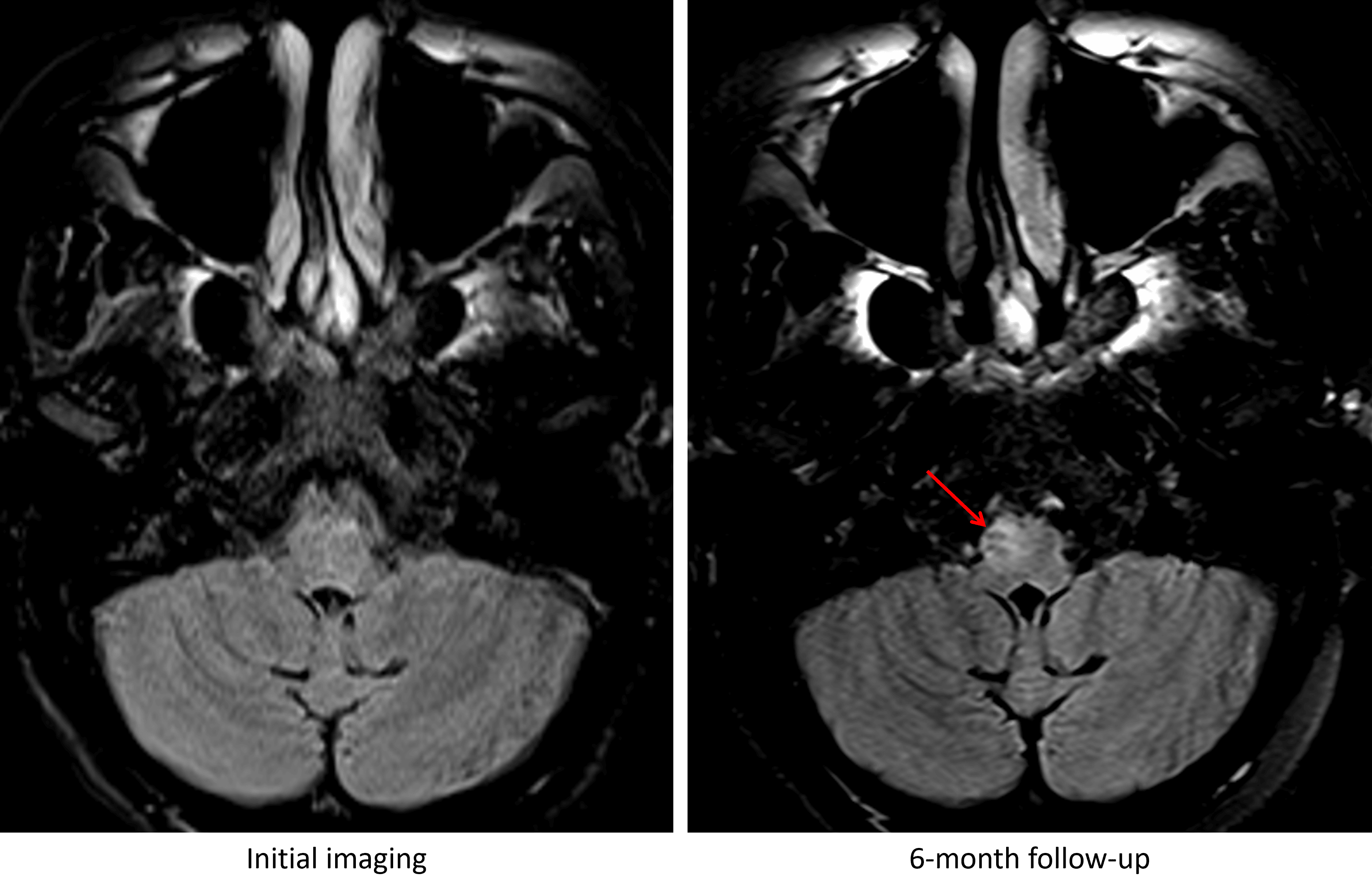 Development of T2/FLAIR signal hyperintensity and enlargement of the right inferior olivary nucleus at 6 month followup imaging (red arrow).