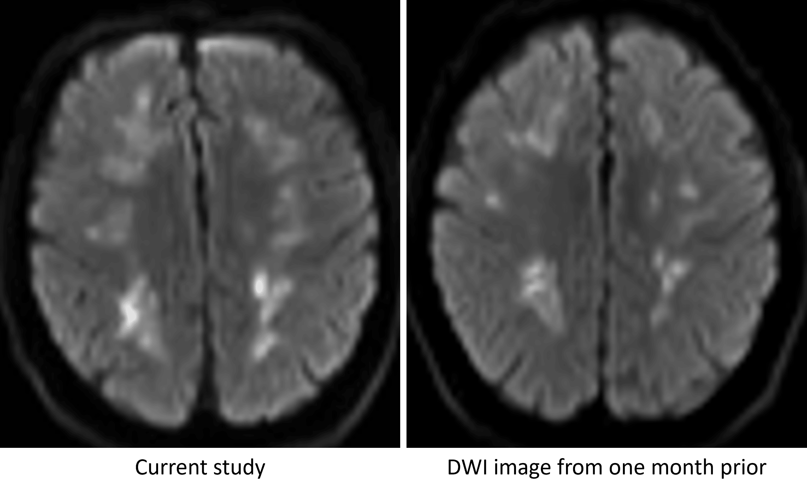 Persistence of restricted diffusion in the cerebral white matter over a one month interval, which is not typical for ischemic infarcts resulting from a single event.