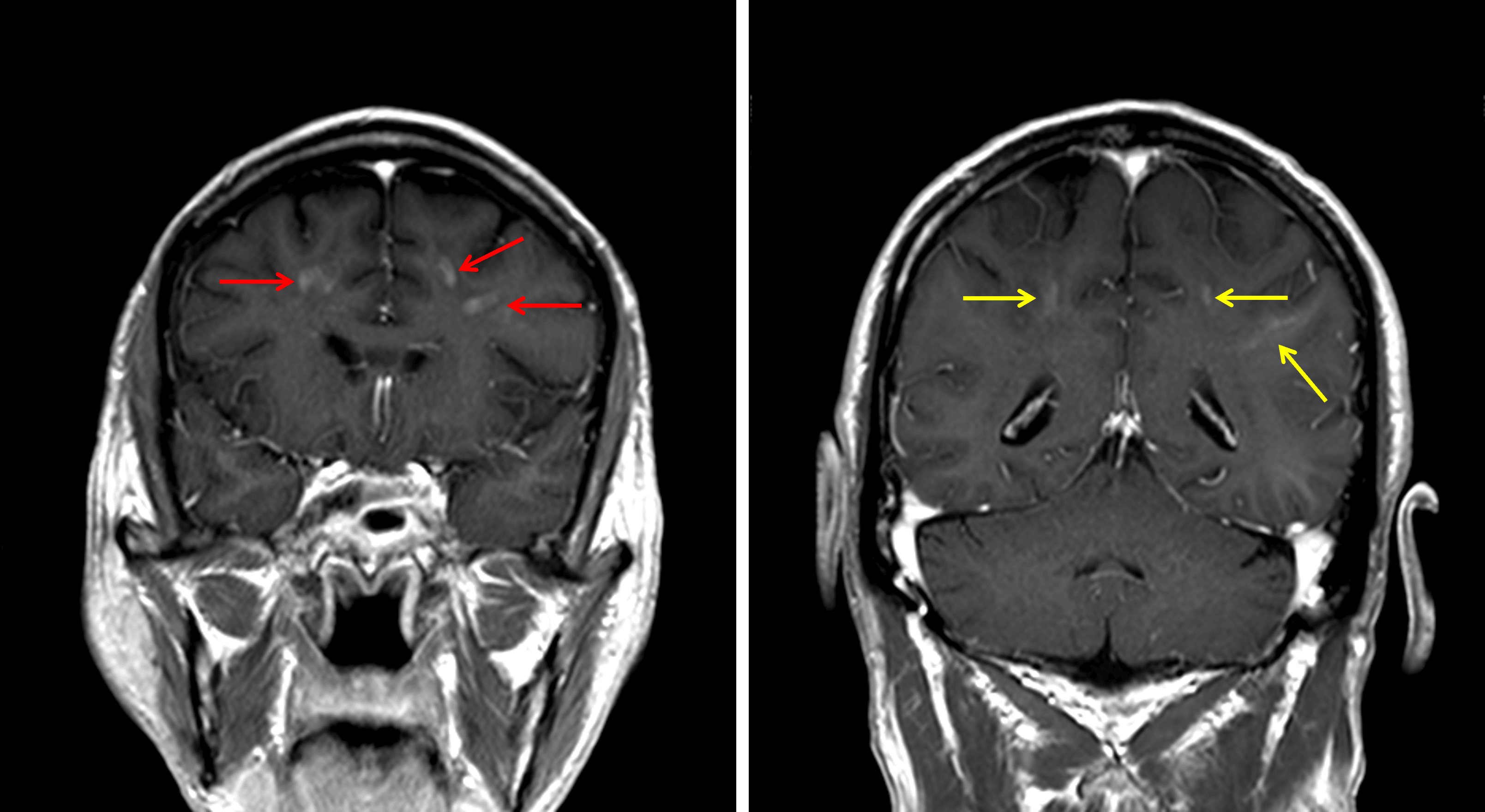 Corresponding areas of enhancement in the frontal lobes (red arrows) and to a lesser extent in the parietal lobes (yellow arrows).