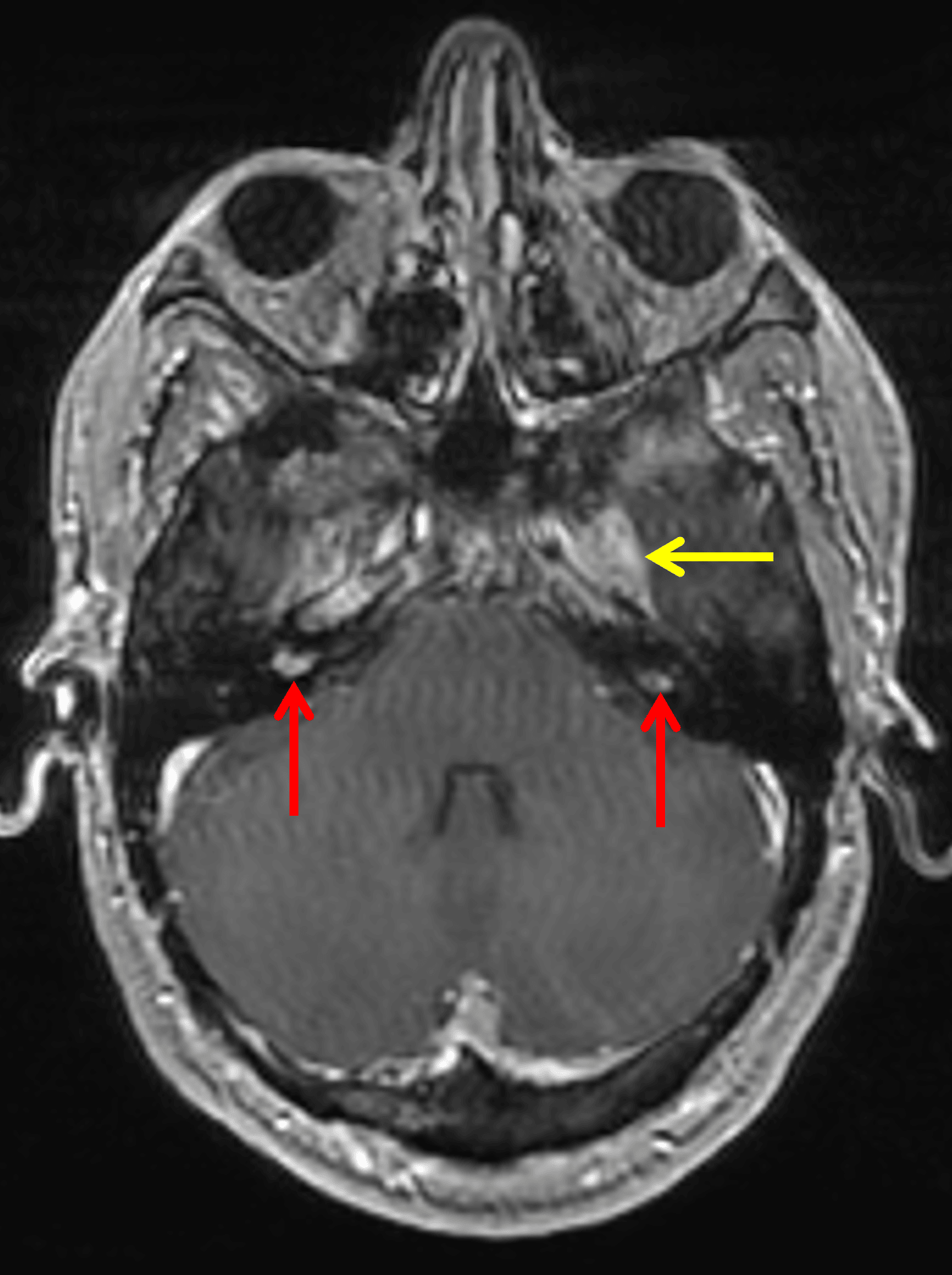 Bilateral vestibular schwannomas (red arrows). Enhancement in the left Meckel's cave extending into the foramen ovale (yellow arrow), also likely a schwannoma.