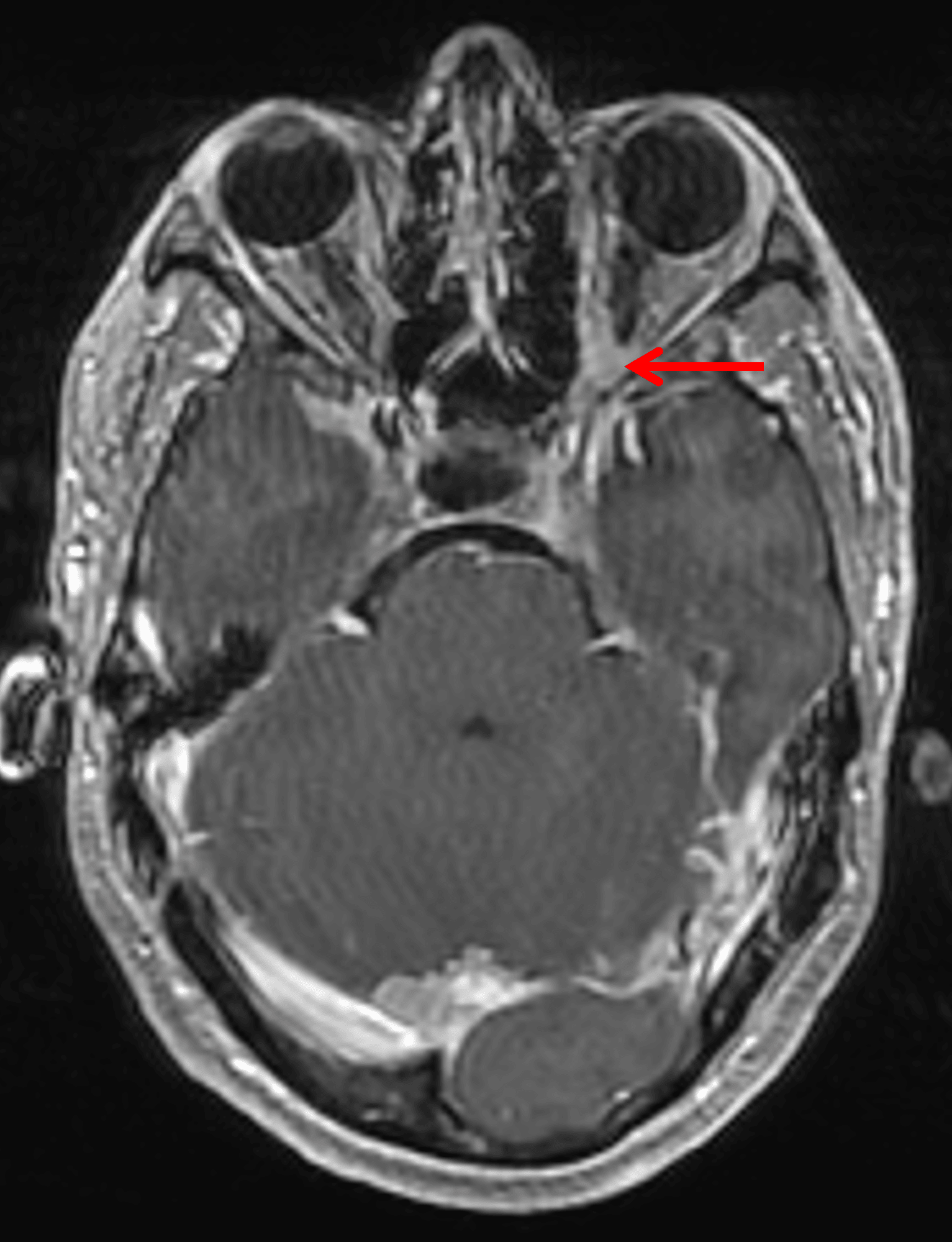 Enhancement in the left orbital apex along the optic nerve (red arrow), likely representing an optic nerve sheath meningioma.