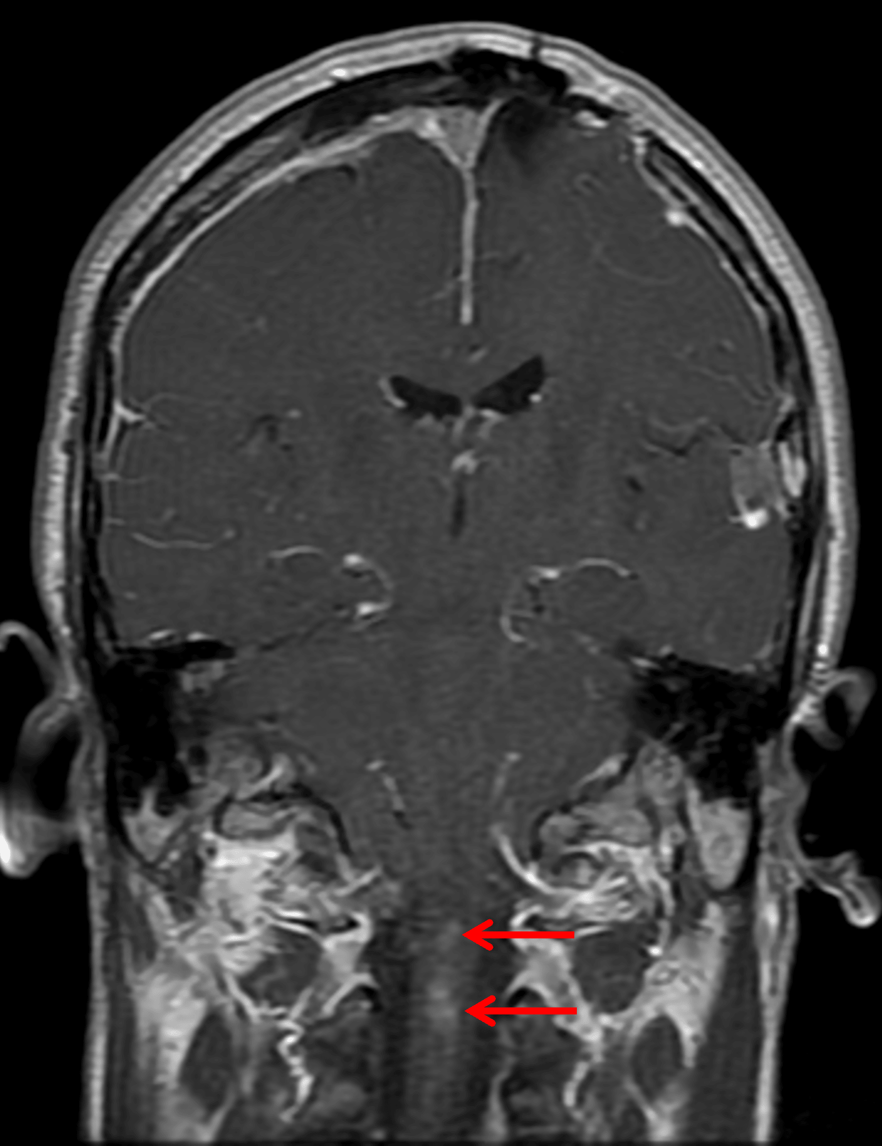 Enhancing intramedullary lesions in the upper cervical spinal cord (red arrows), likely representing ependymomas.