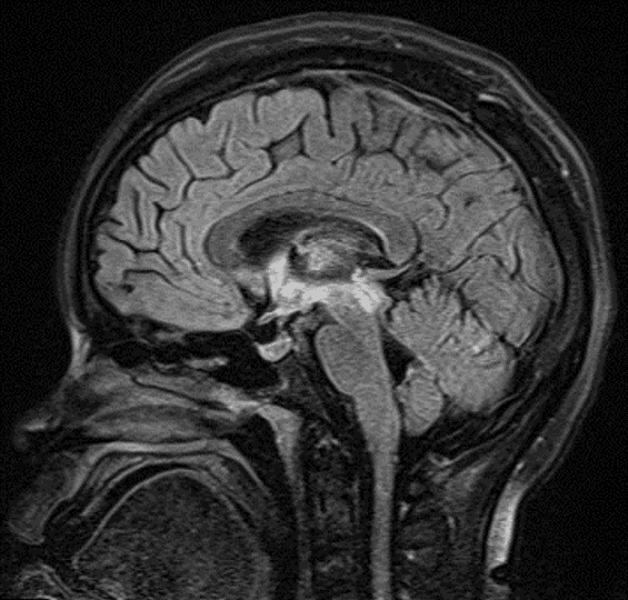 FLAIR signal hyperintensity along the ependymal margins of the third ventricle and cerebral aqueduct, extending into the right greater than left thalami.