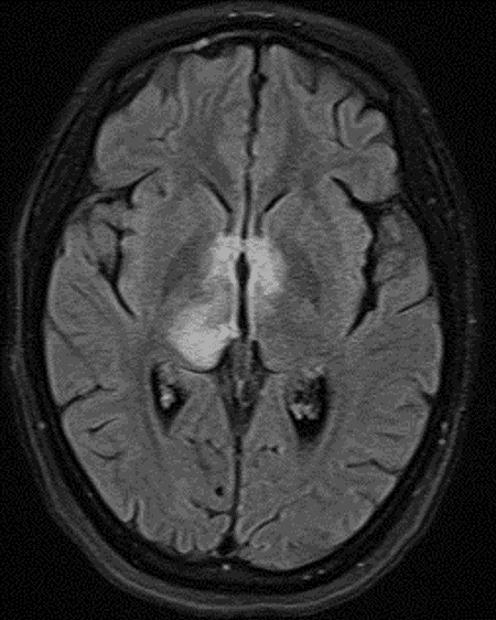 FLAIR signal hyperintensity along the ependymal margins of the third ventricle and cerebral aqueduct, extending into the right greater than left thalami.