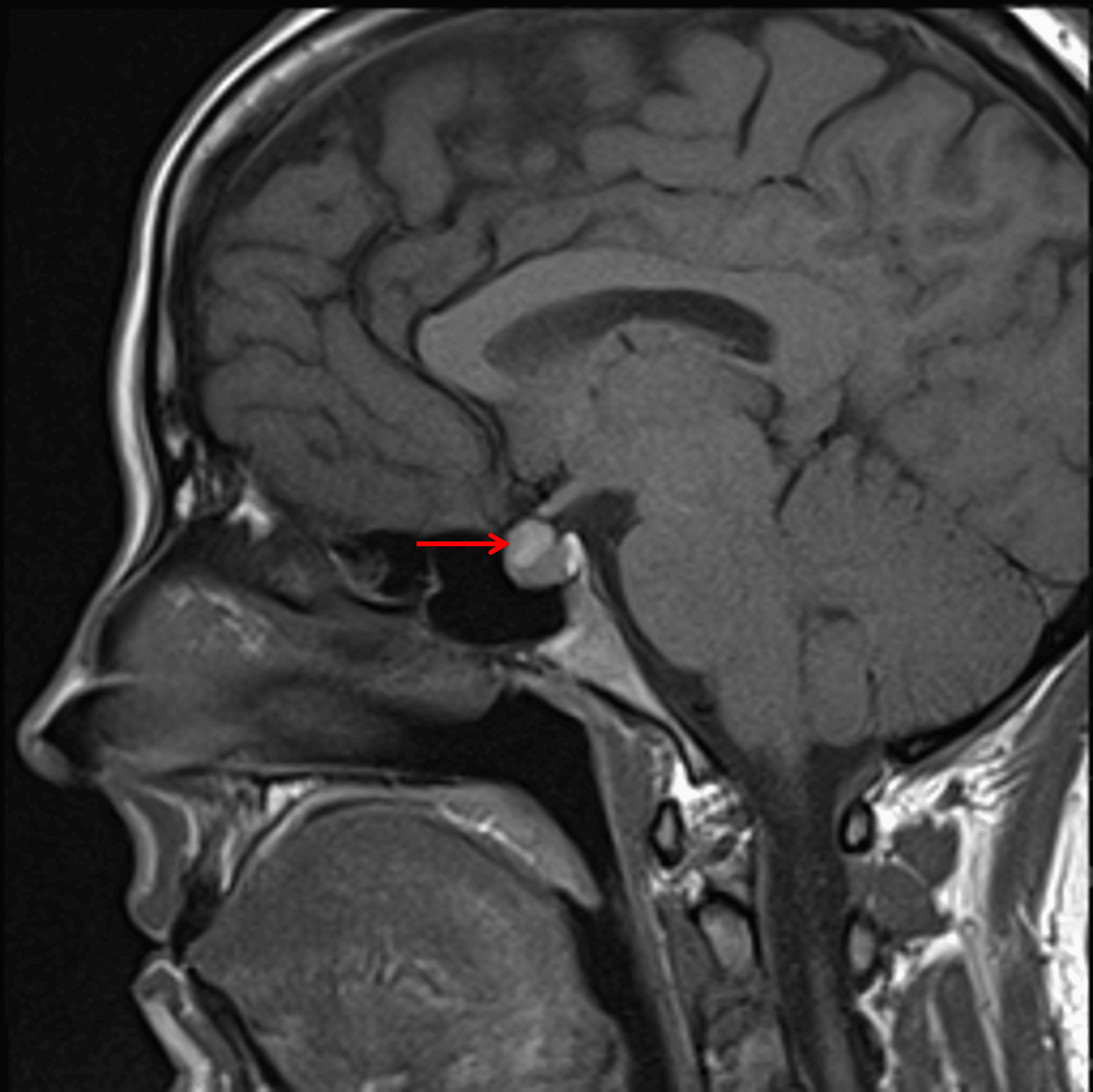 T1 hyperintense lesion along the superior margin of the pituitary gland (red arrow).