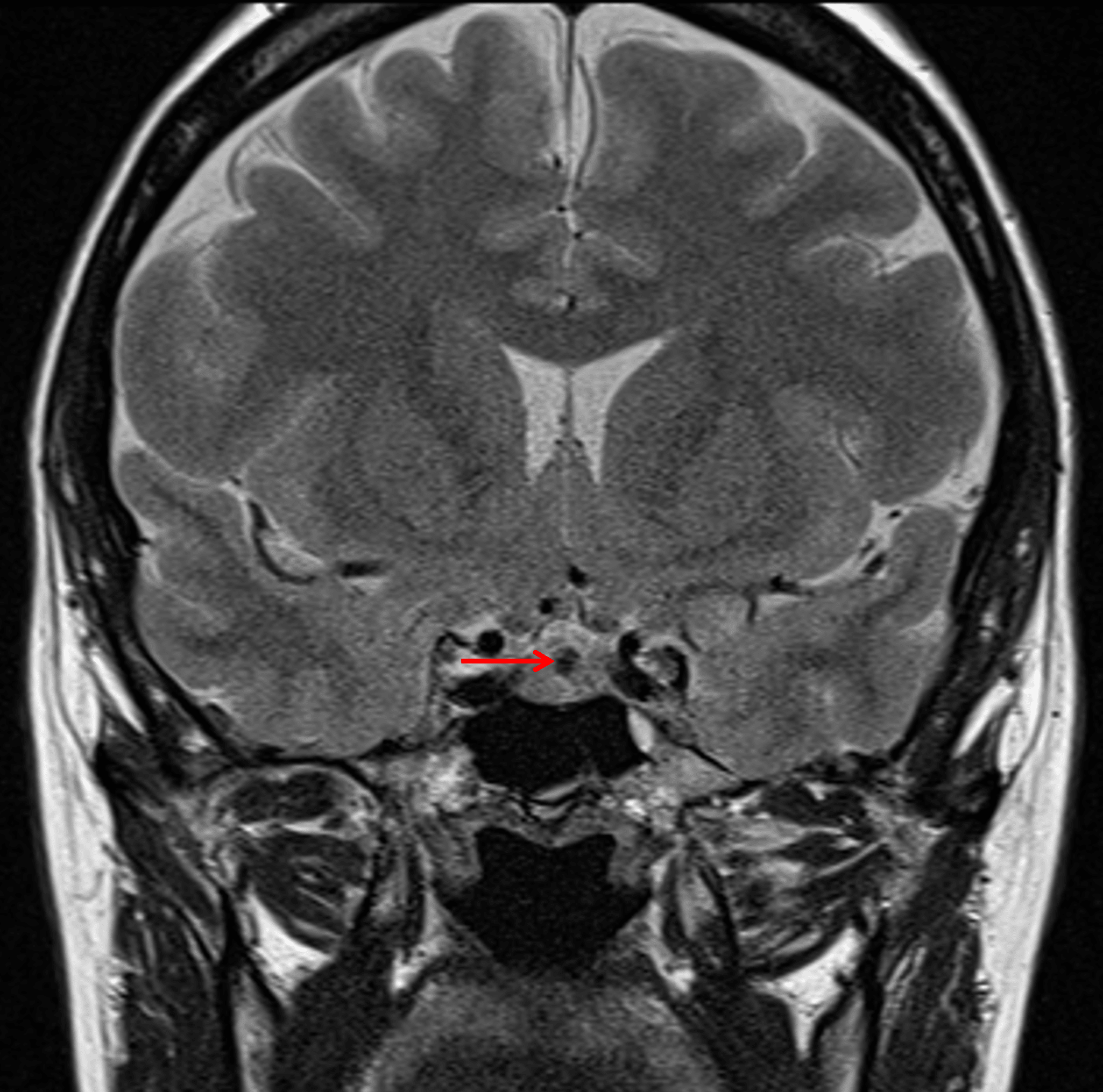 Intralesional T2 hypointense nodule (red arrow), which is a characteristic finding for Rathke cleft cysts.