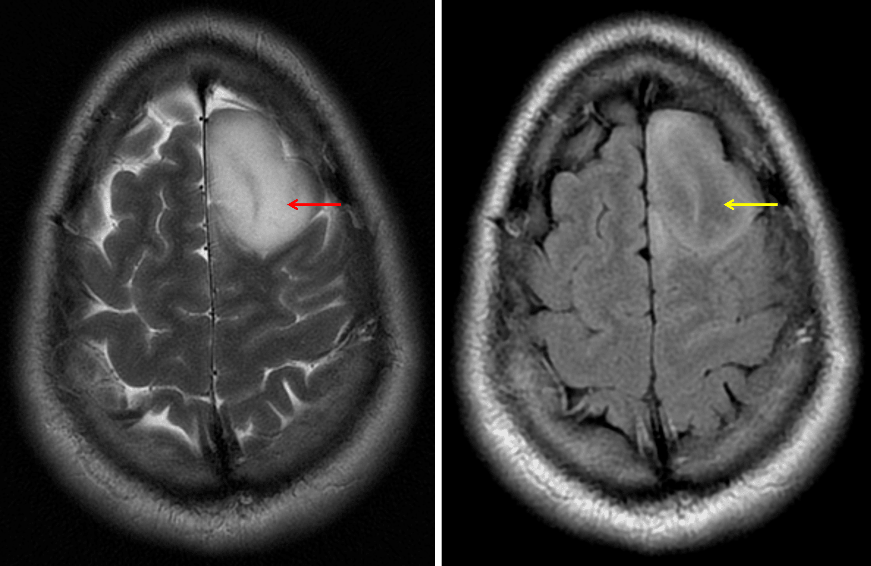 The T2-FLAIR mismatch sign: the lesion demonstrates internal T2 signal hyperintensity (red arrow) contrasted to relatively hypointense FLAIR signal (yellow arrow).
