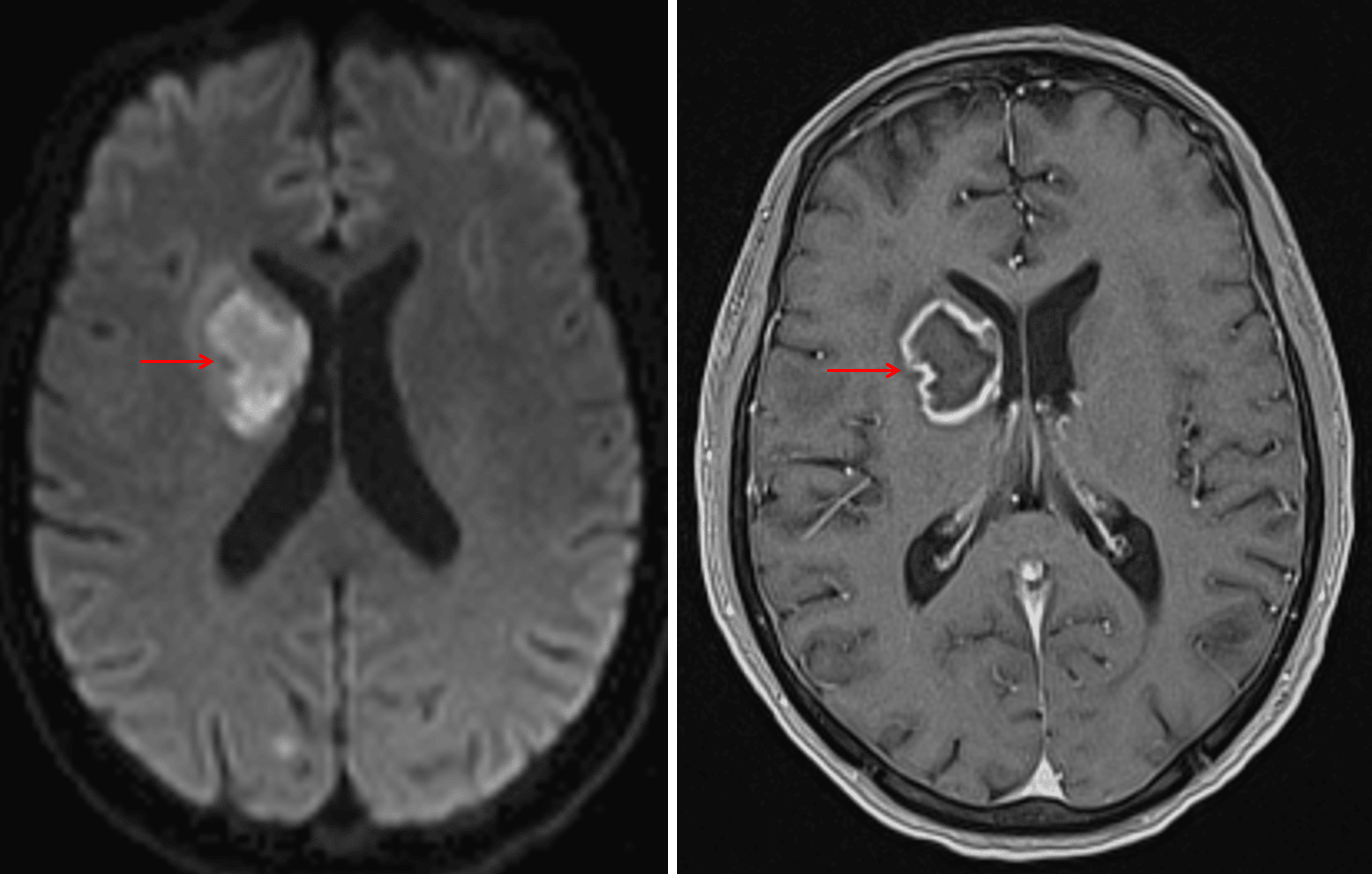 Peripherally-enhancing lesion with central restricted diffusion in the right basal ganglia and internal capsule (red arrows), highly concerning for a pyogenic abscess. Close proximity to the ventricular margin increases the risk for ventriculitis.