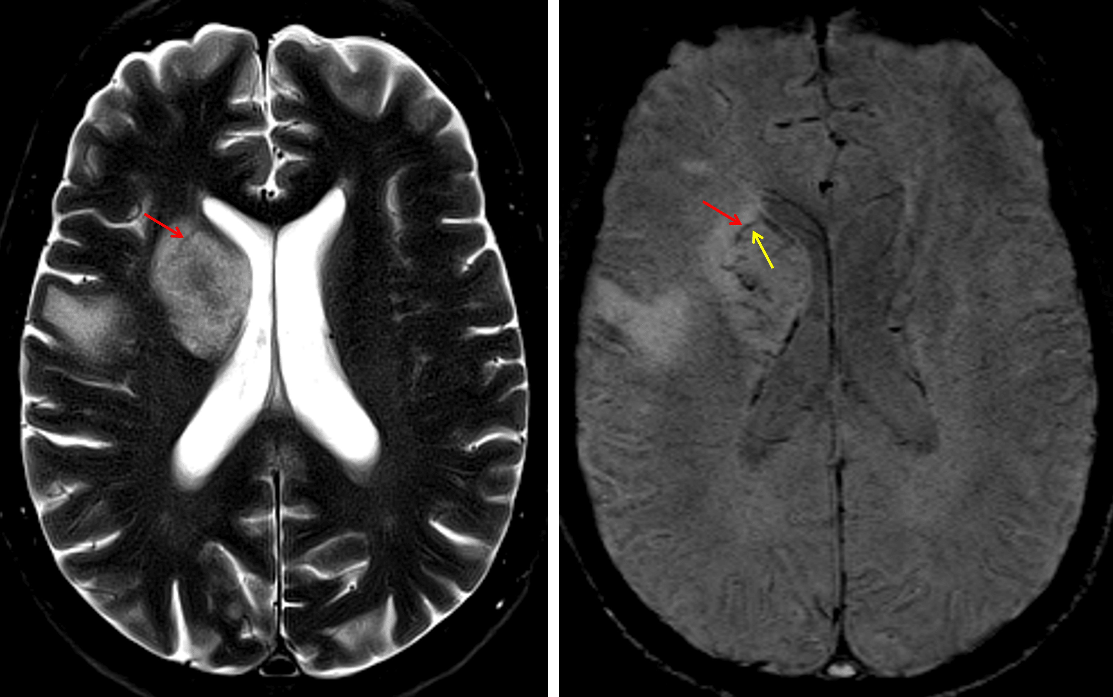 Although this case is not the best example of an abscess rim, there is a thin T2 and SWI hypointense rim (red arrows) with a thin internal SWI hyperintense ring (yellow arrow).