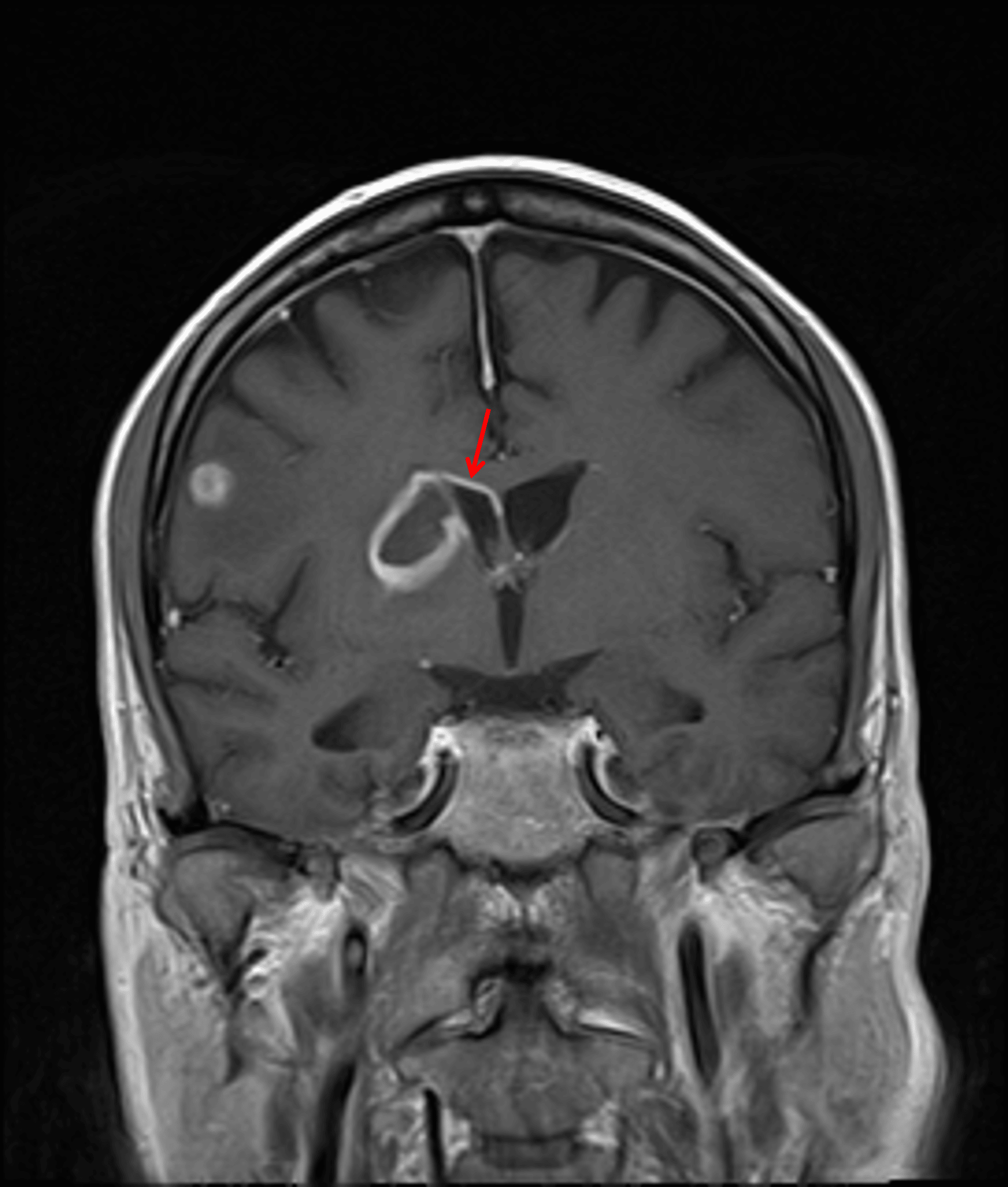Enhancement extending along the superior margin of the right lateral ventricle (red arrow), which raises concern for developing ventriculitis.
