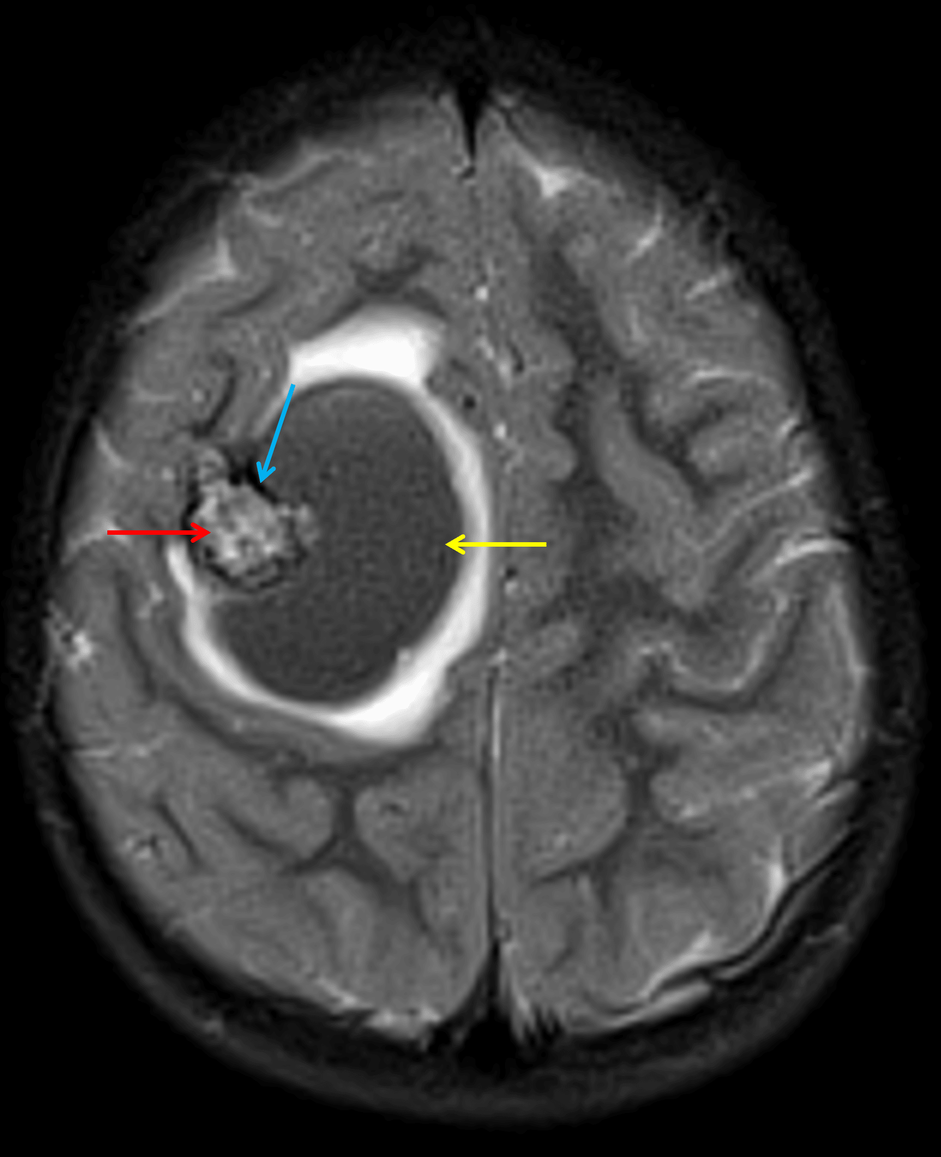 Lesion in the right frontal lobe with heterogeneous internal T2 signal intensity (red arrow), a rim of T2 signal hypointensity (blue arrow), and an adjacent hematoma (yellow arrow) with surrounding edema.