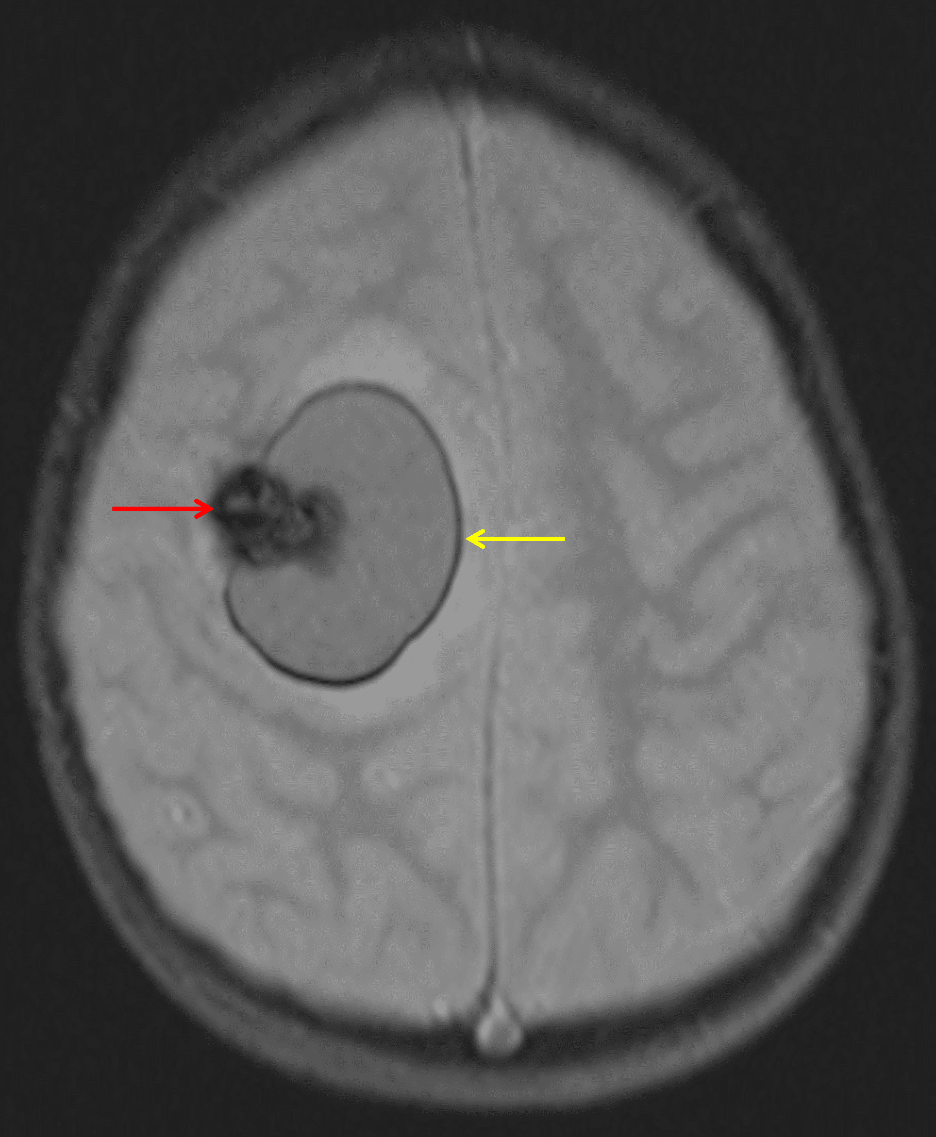 The lesion demonstrates extensive corresponding susceptibility artifact (red arrow). In addition, there is a rim of susceptibility artifact along the adjacent hematoma (yellow arrow).