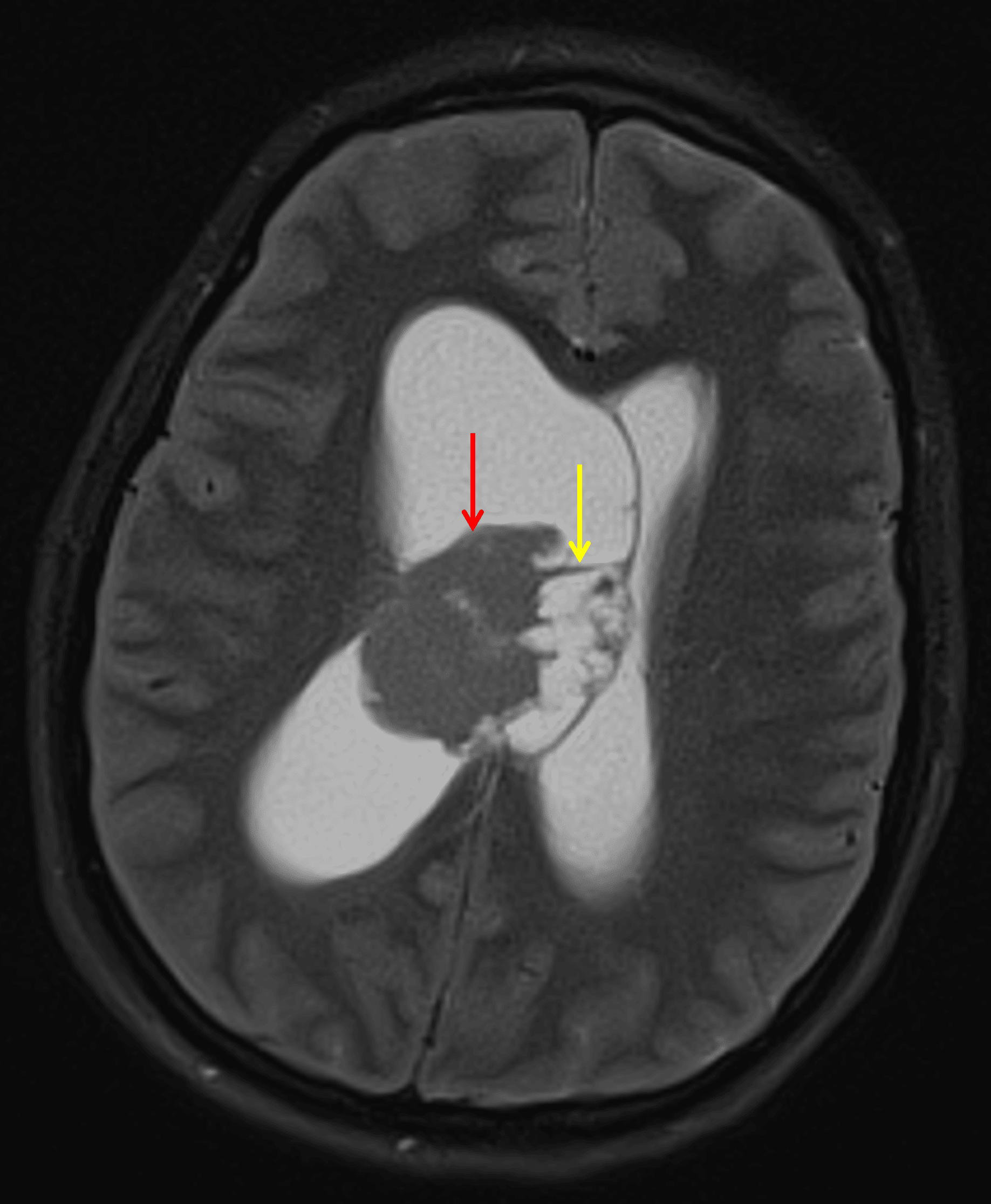 Mass in the body of the right lateral ventricle with a solid component laterally (red arrow) and a cystic component medially (yellow arrow).