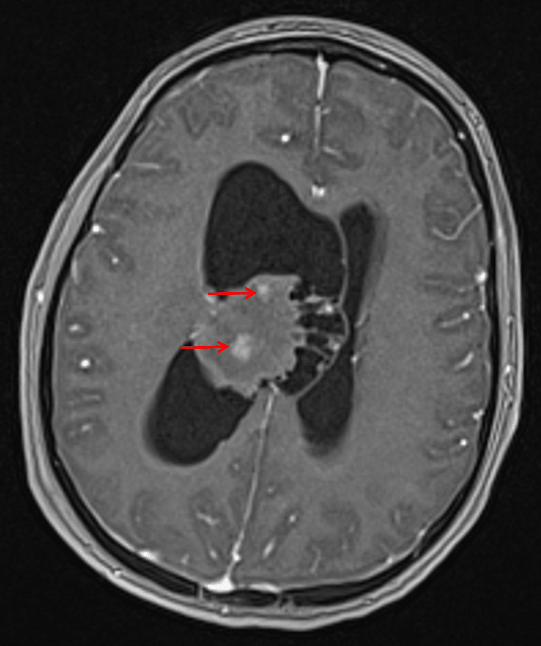 Internal patchy areas of enhancement (red arrows).