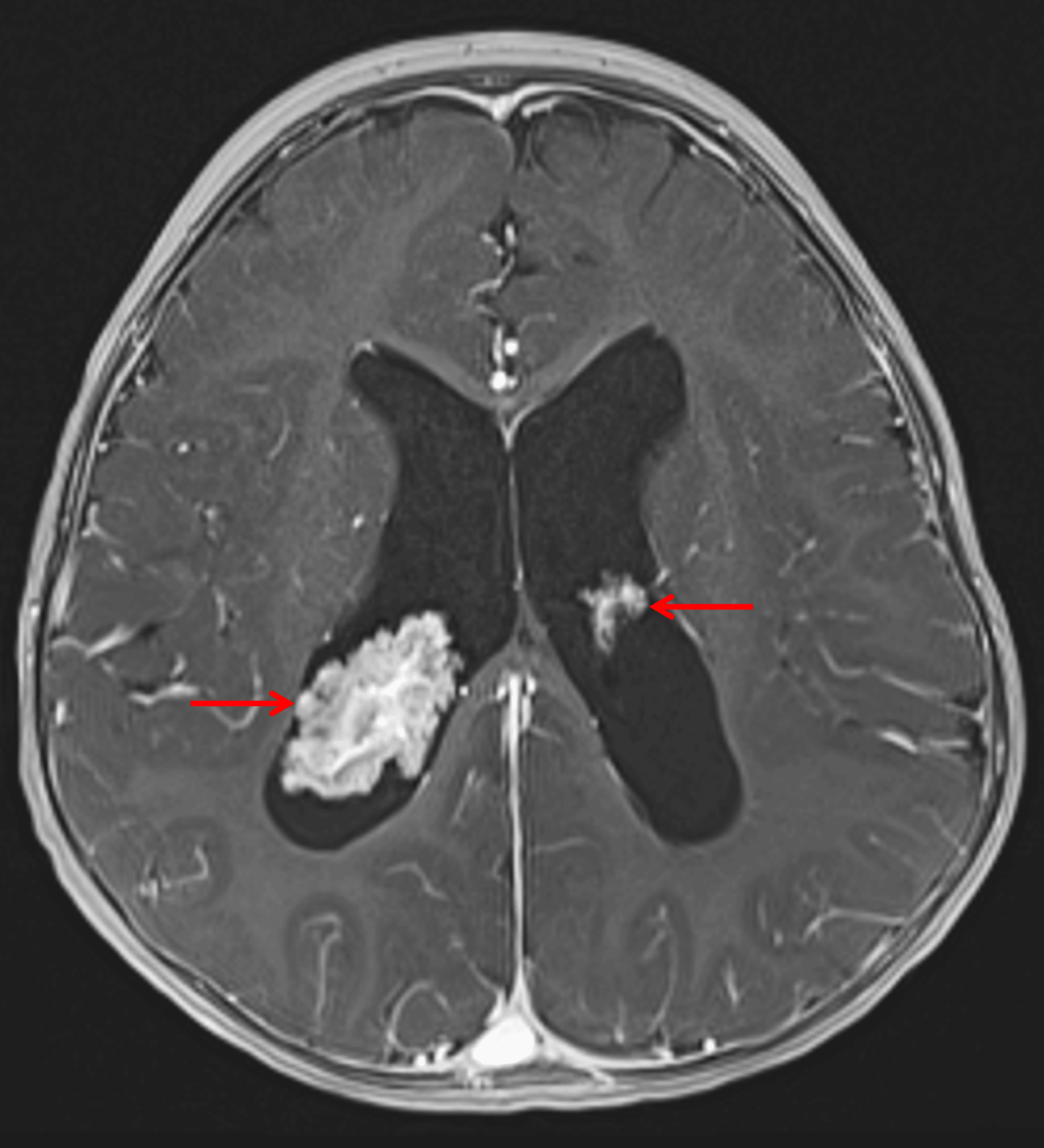 Enlargement of the right greater than left choroid plexus in the lateral ventricles (red arrows).
