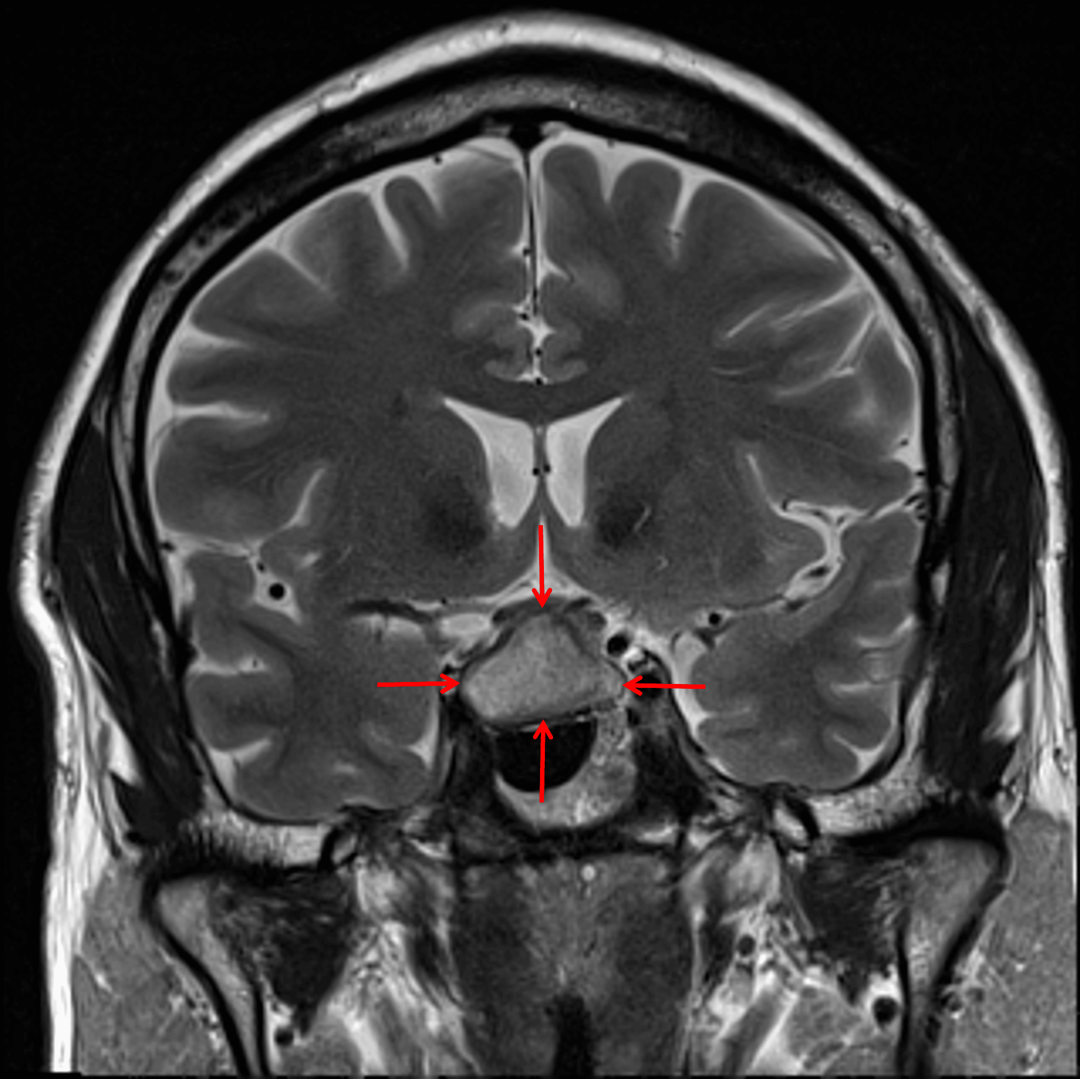 Cystic sellar/suprasellar mass with internal T2 signal hyperintensity (red arrows).