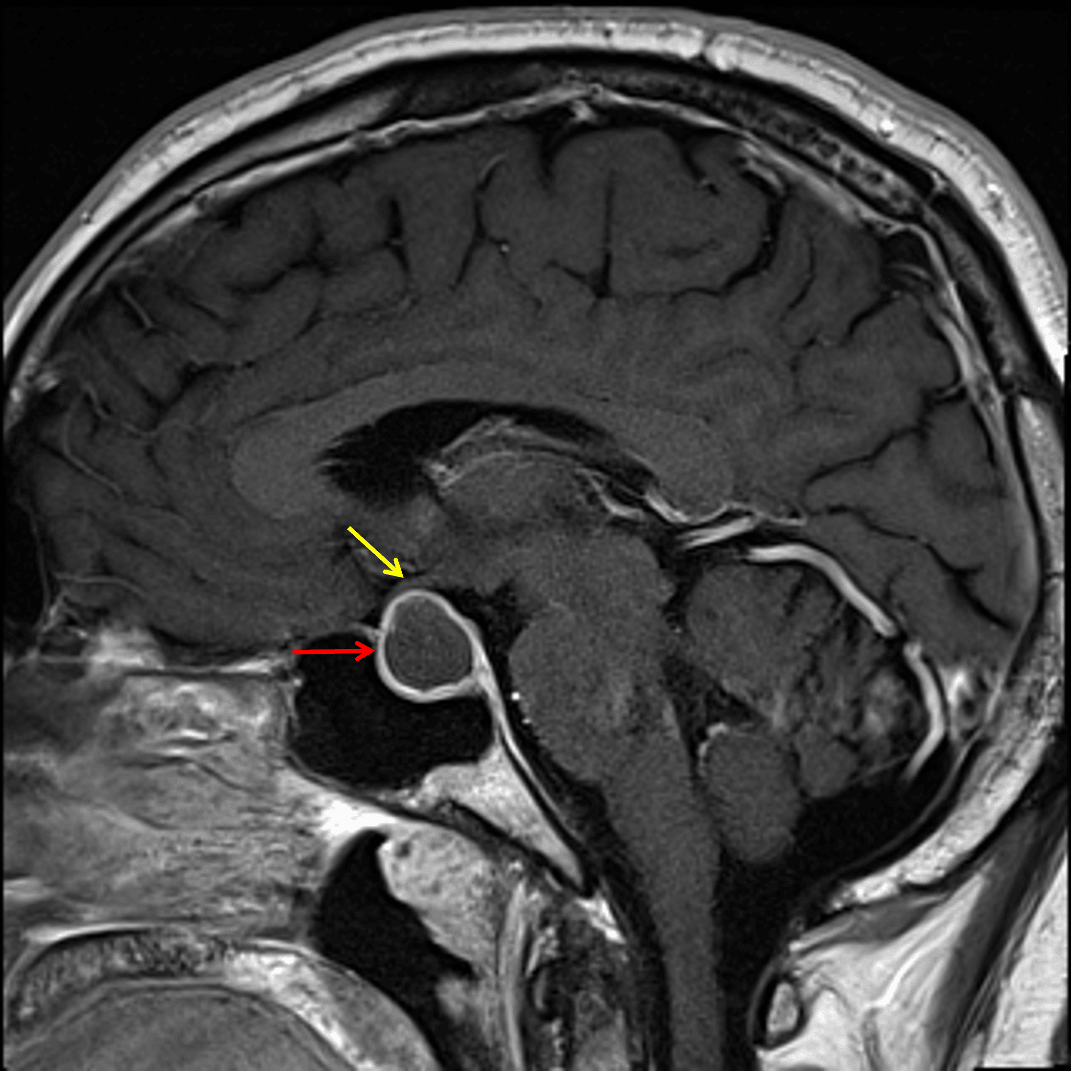 The lesion demonstrates peripheral enhancement (red arrow) and contacts and mildly uplifts the optic chiasm (yellow arrow).