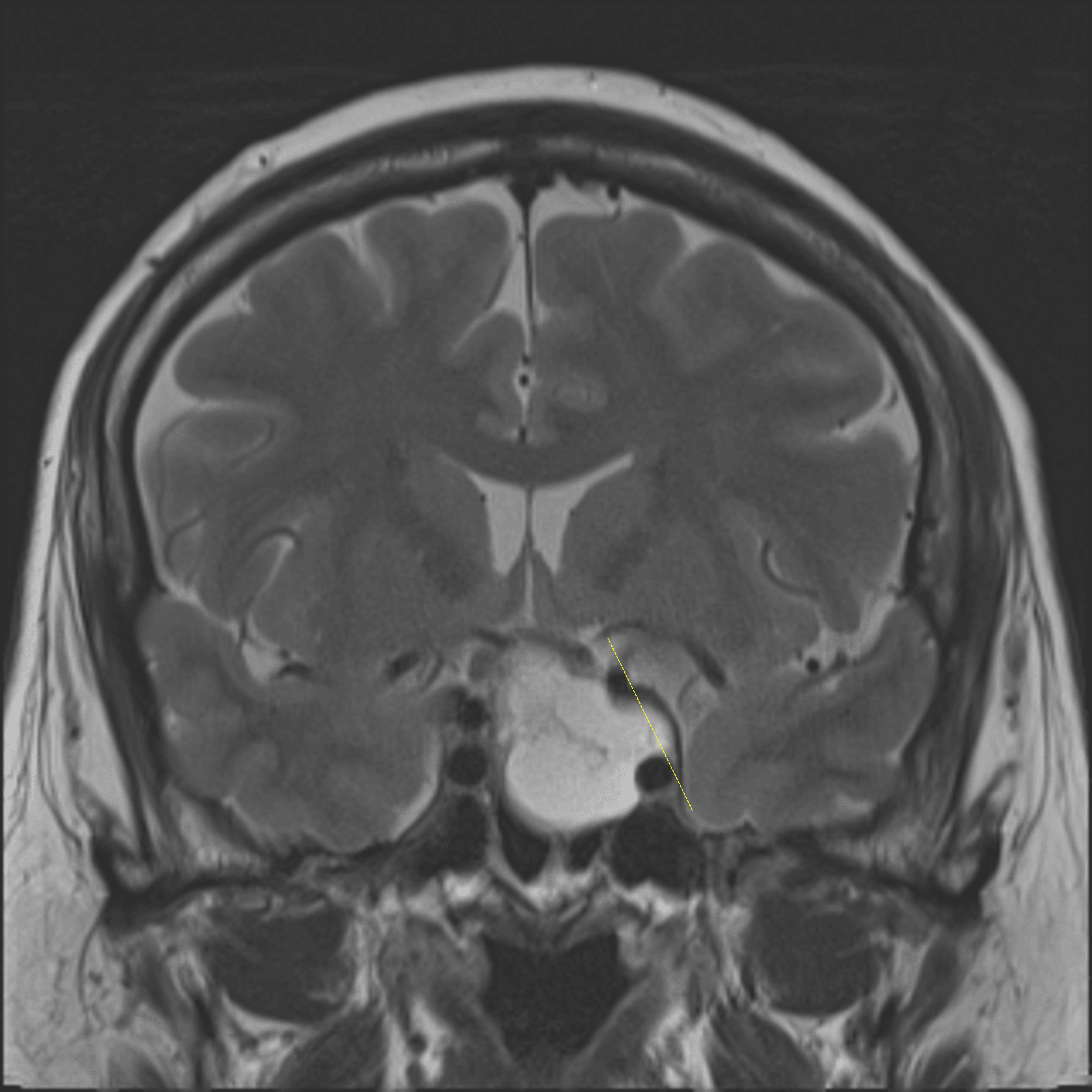 Tumor bulges lateral to the left lateral carotid tangent line (yellow dotted line), suggesting cavernous sinus invasion.