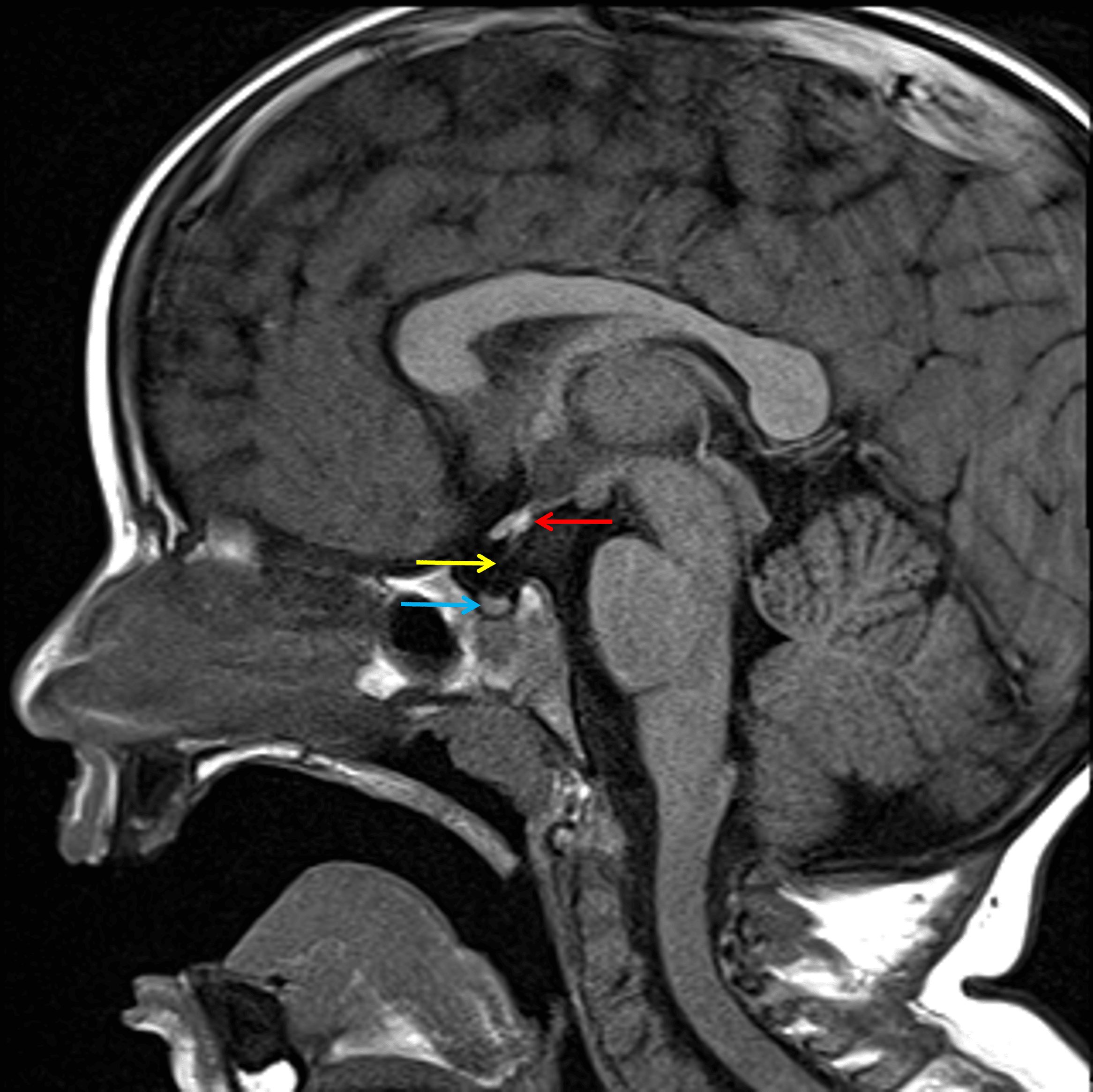 Ectopic posterior pituitary at the base of the pituitary stalk (red arrow) with hypoplastic appearance of the pituitary stalk (yellow arrow) and possibly also of the adenohypophysis (blue arrow).