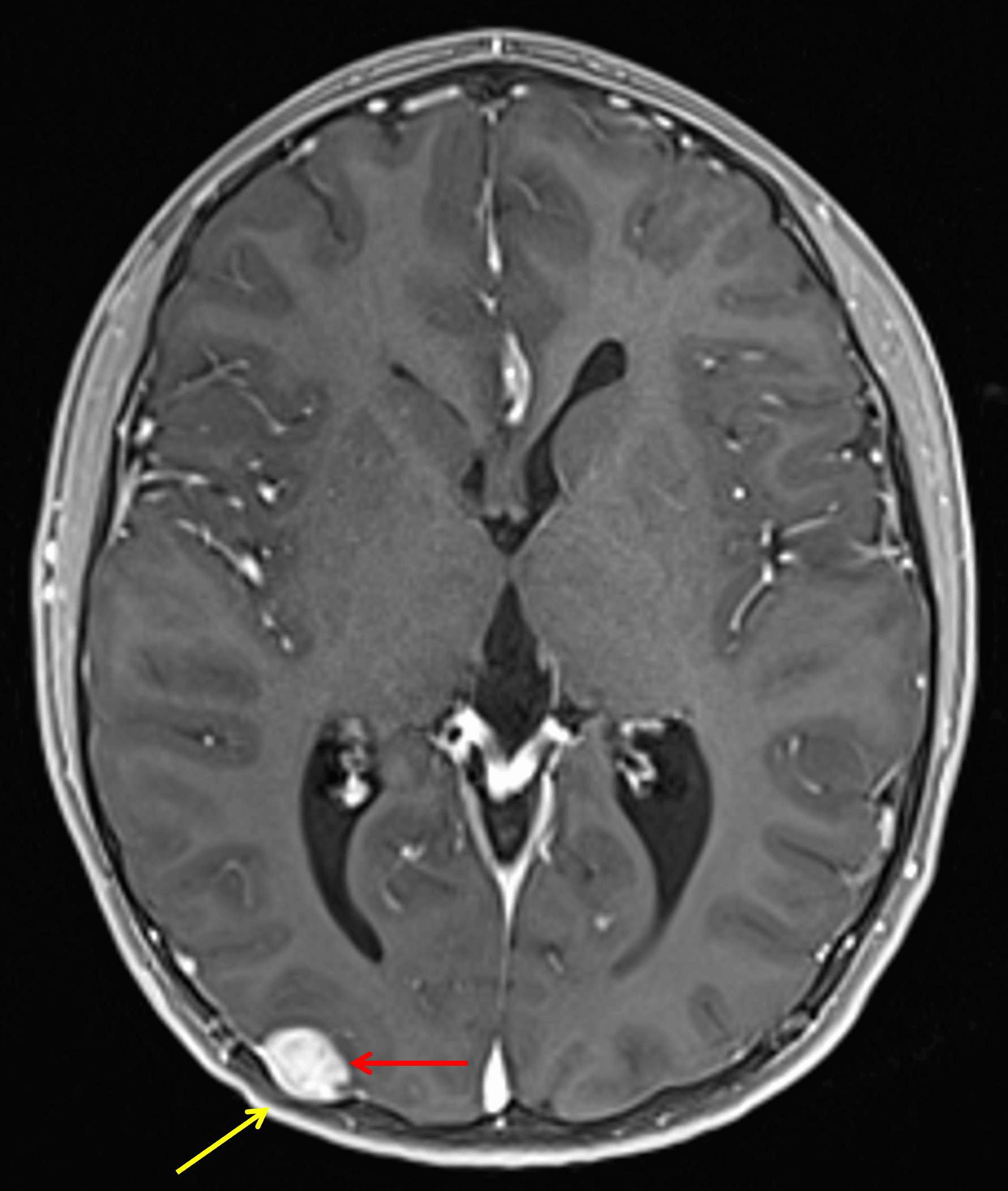 Corresponding nodular enhancement (red arrow) with overlying calvarial scalloping (yellow arrow).