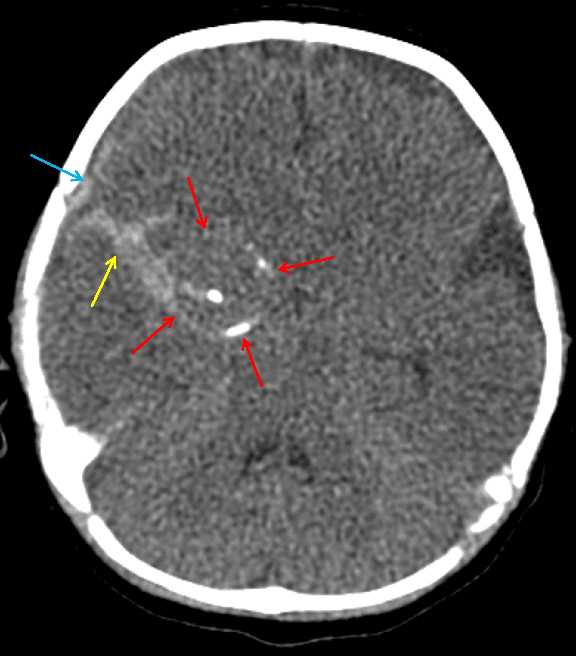 Peripherally-calcified lesion along the right temporal lobe (red arrows) with adjacent subarachnoid (yellow arrow) and subdural (blue arrow) hemorrhage.