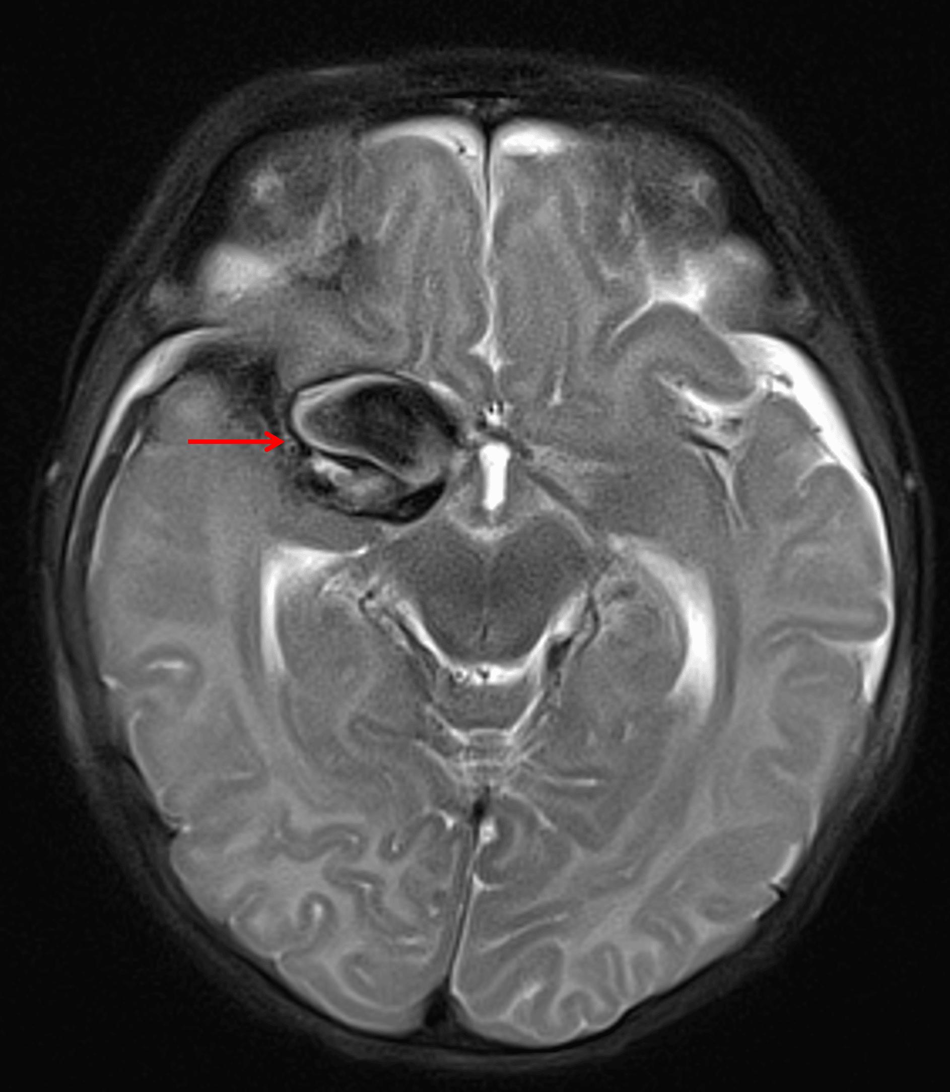 Corresponding markedly hypointense T2 signal with a swirling internal configuration (red arrow).