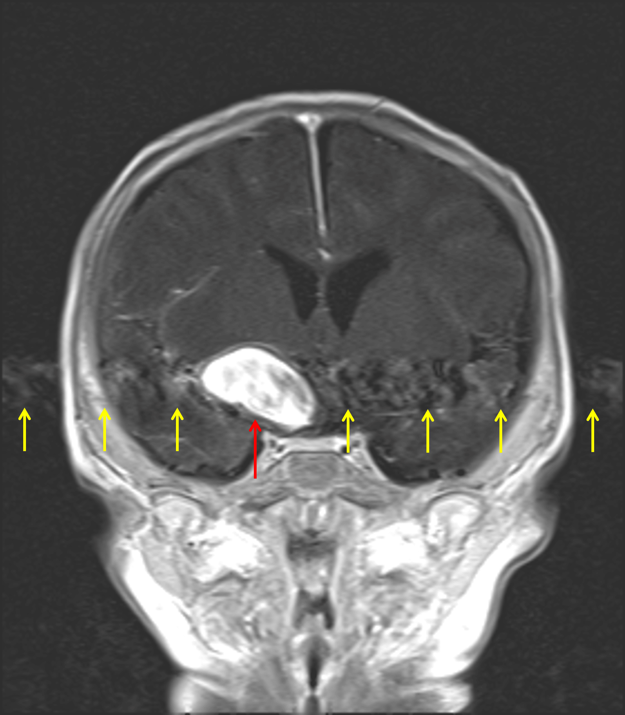 Diffuse internal enhancement on postcontrast imaging (red arrow) with corresponding radiating pulsation artifact (yellow arrows).