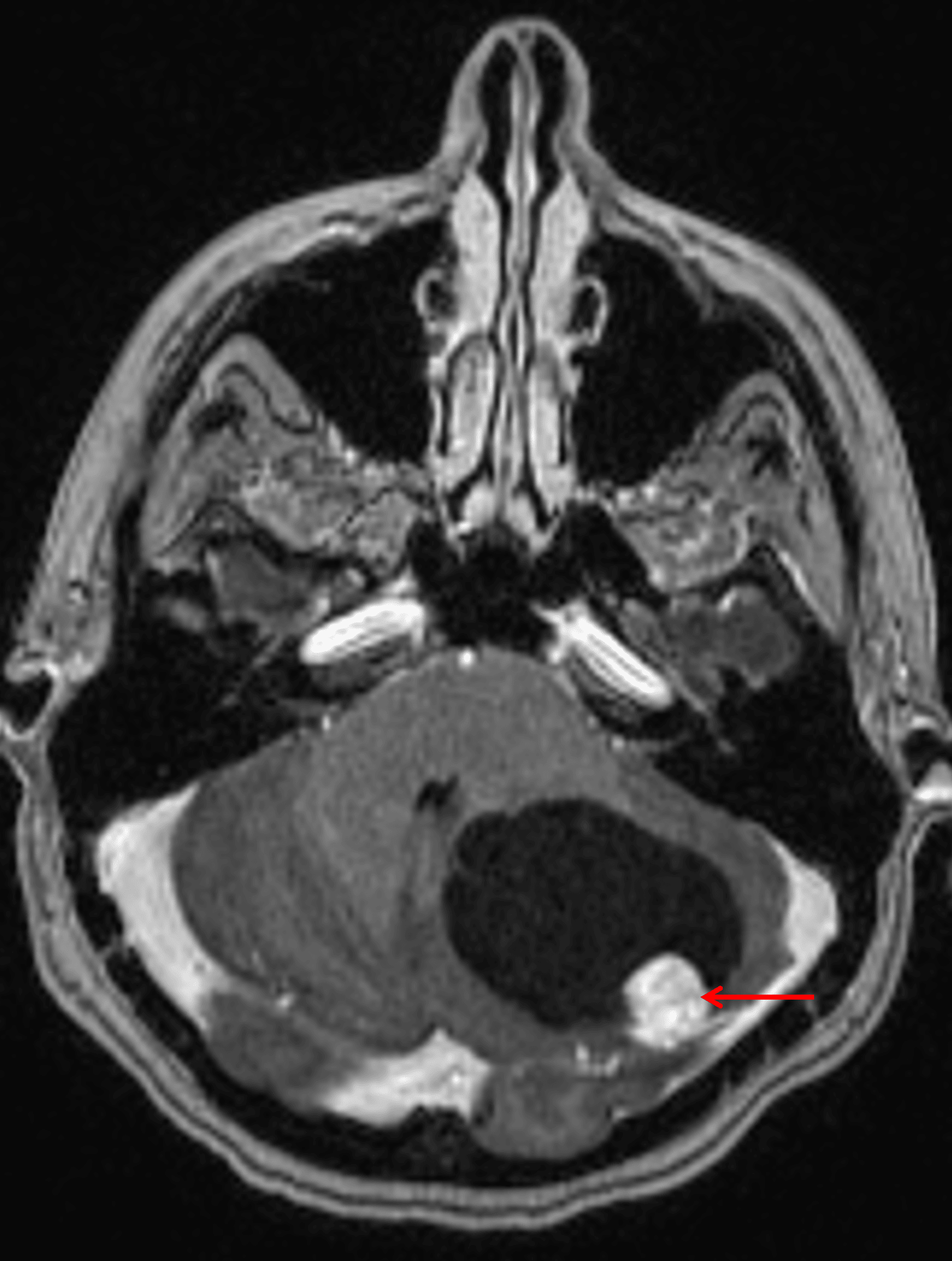 Cystic mass in the left cerebellar hemisphere with an avidly enhancing mural nodule (red arrow).