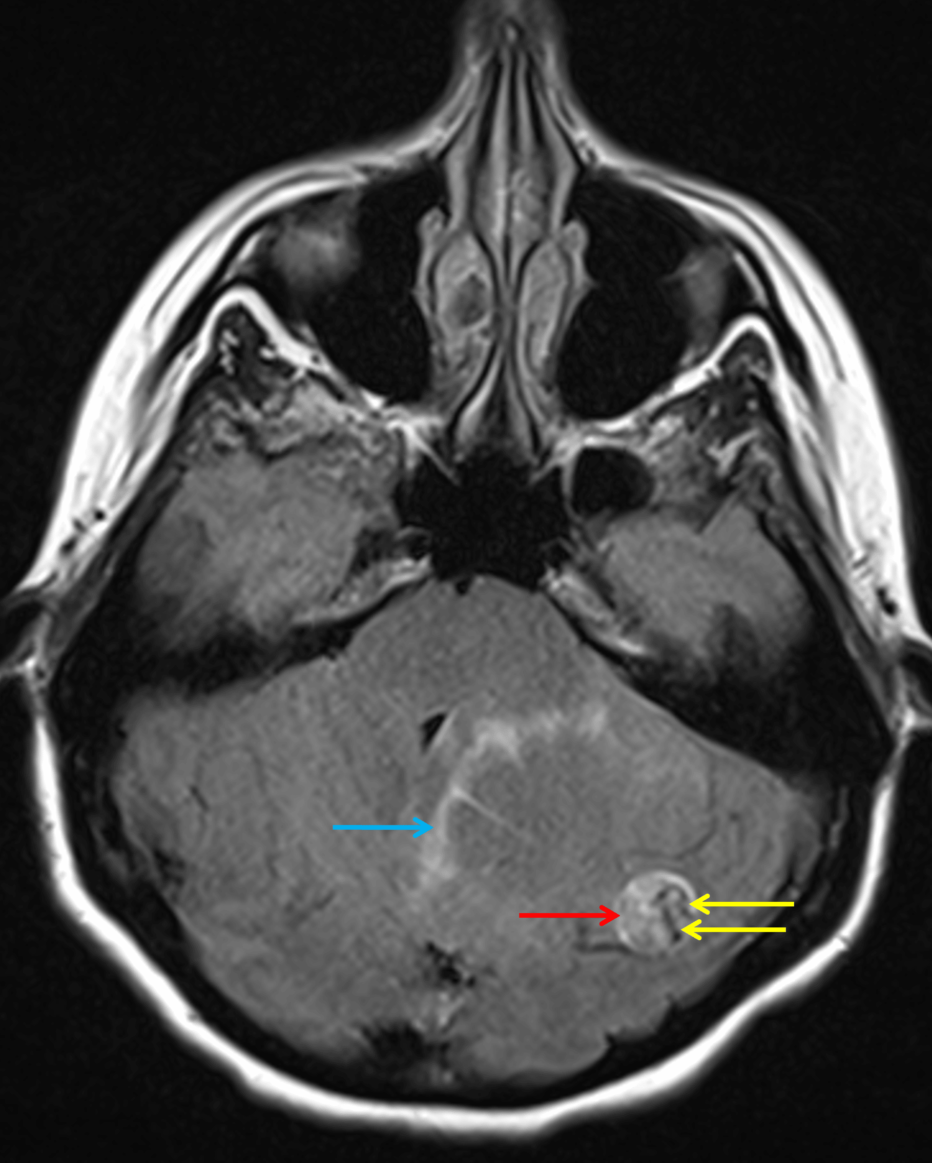Axial FLAIR sequence demonstrates hyperintense signal within the solid component (red arrow) contrasted with serpiginous hypointense flow voids (yellow arrows). Minimal parenchymal edema is noted along the margins of the cystic component of the mass (blue arrow).