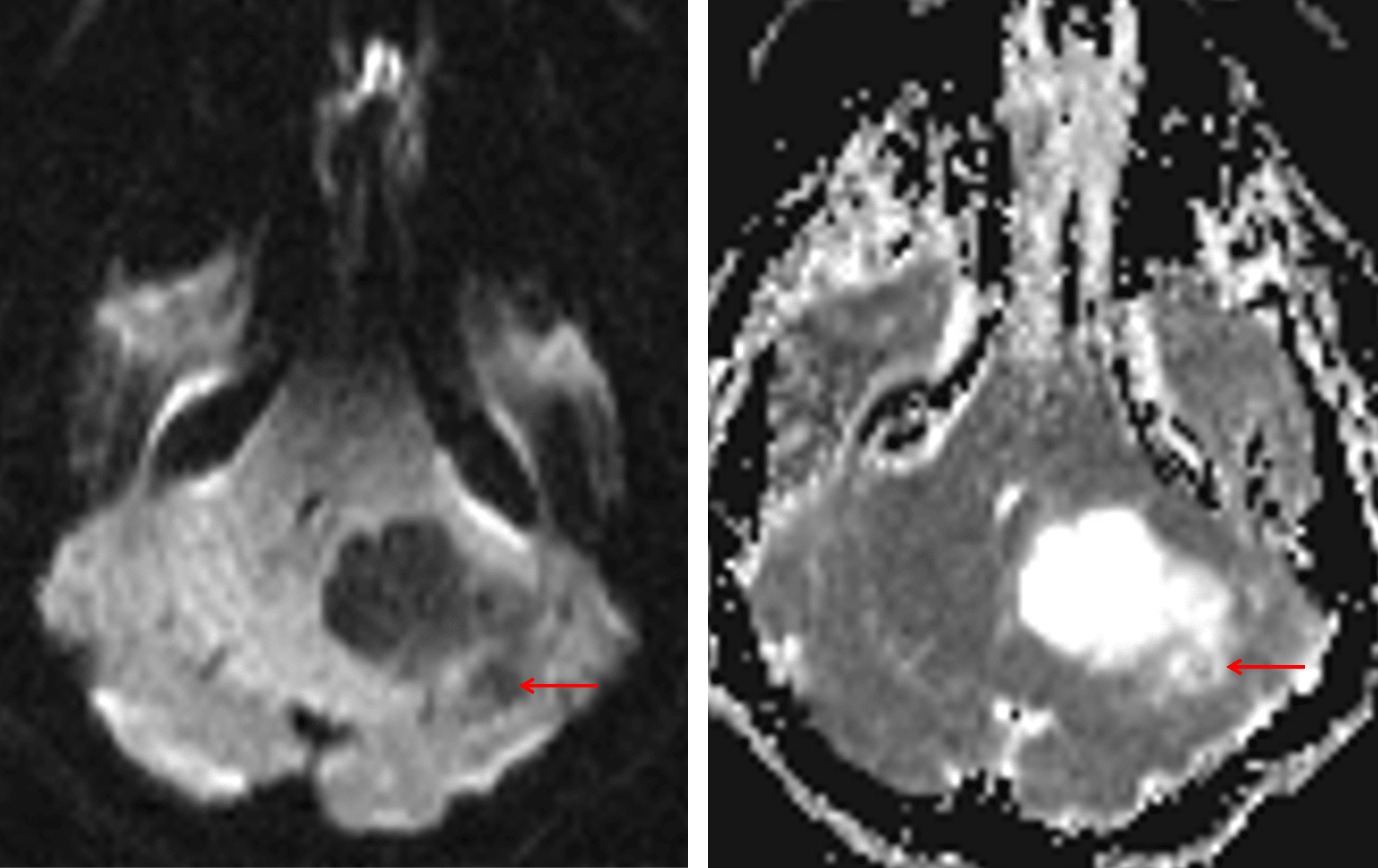 Relative facilitated diffusion (low DWI signal and high ADC signal, red arrows) is demonstrated in the solid portion of the mass relative to brain parenchyma.