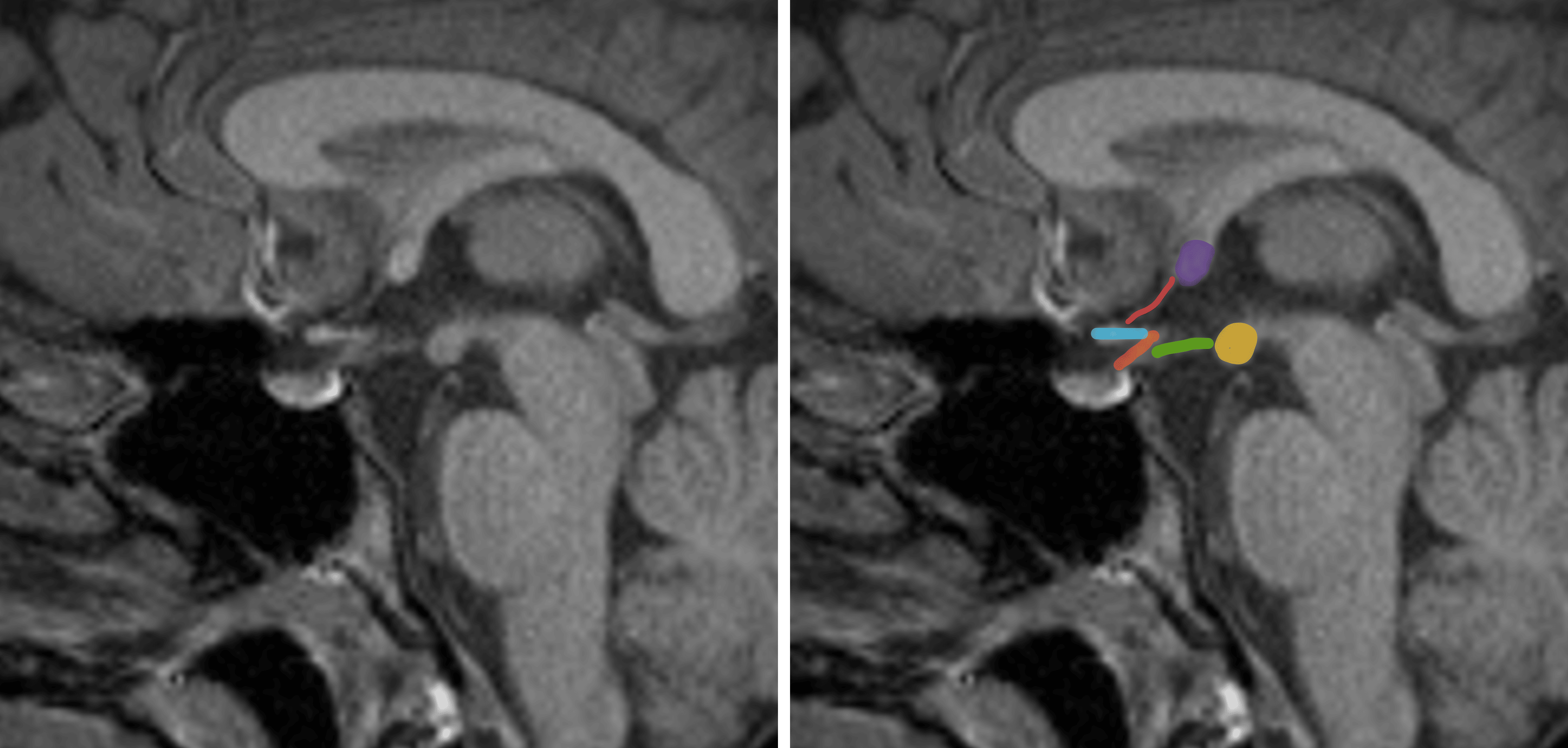 Relevant anatomic structures on a midline sagittal image in and around the hypothalamus: purple - anterior commissure, pink - lamina terminalis, blue - optic chiasm, orange - pituitary infundibulum, green - tuber cinereum, yellow - mammillary body.
